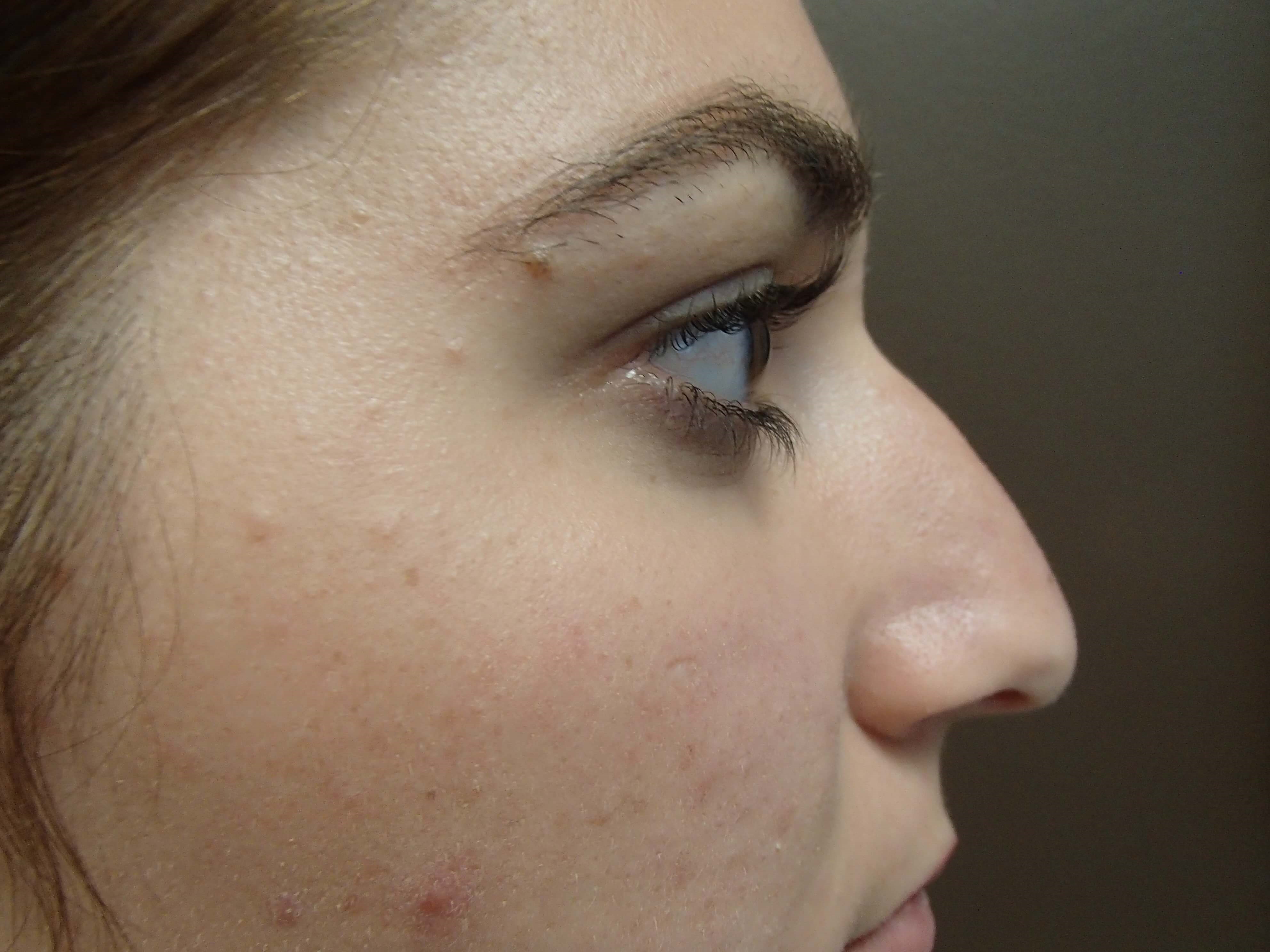 Rhinoplasty Before