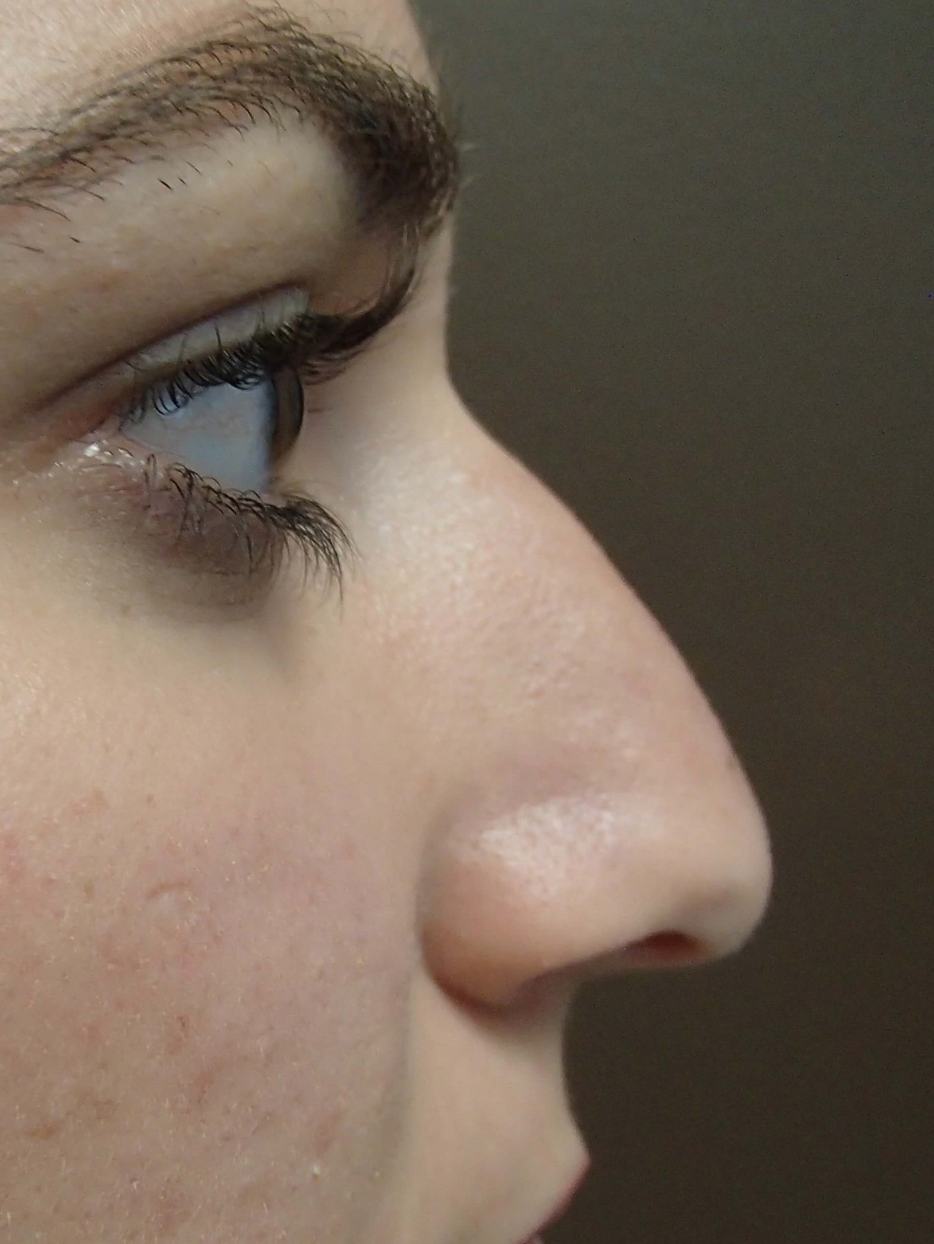 Rhinoplasty Before