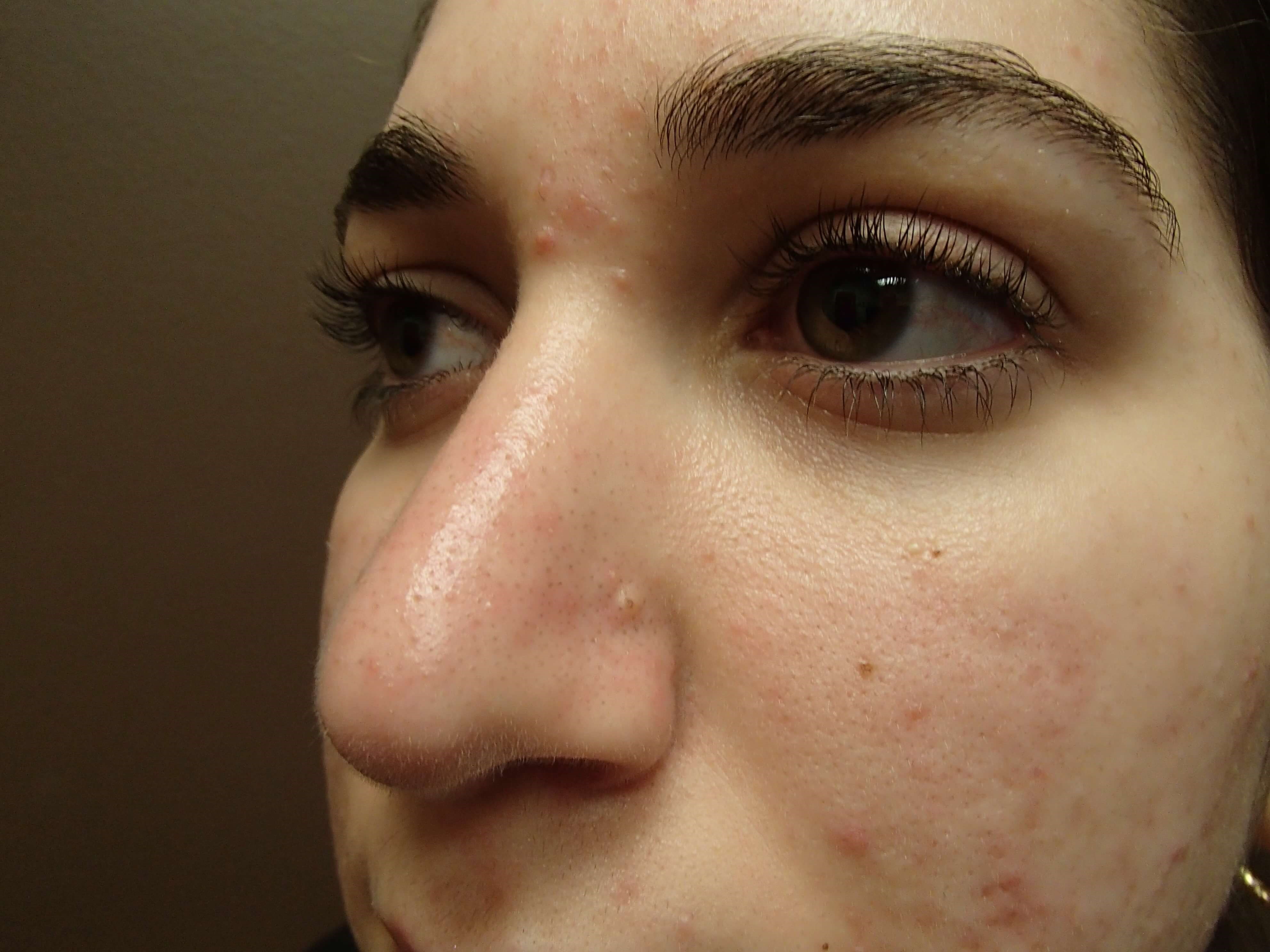 Rhinoplasty After
