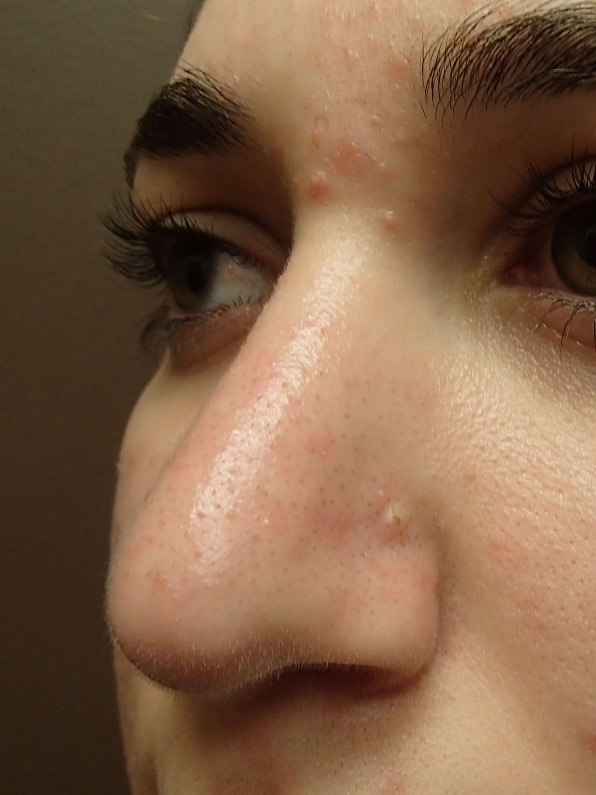 Rhinoplasty After
