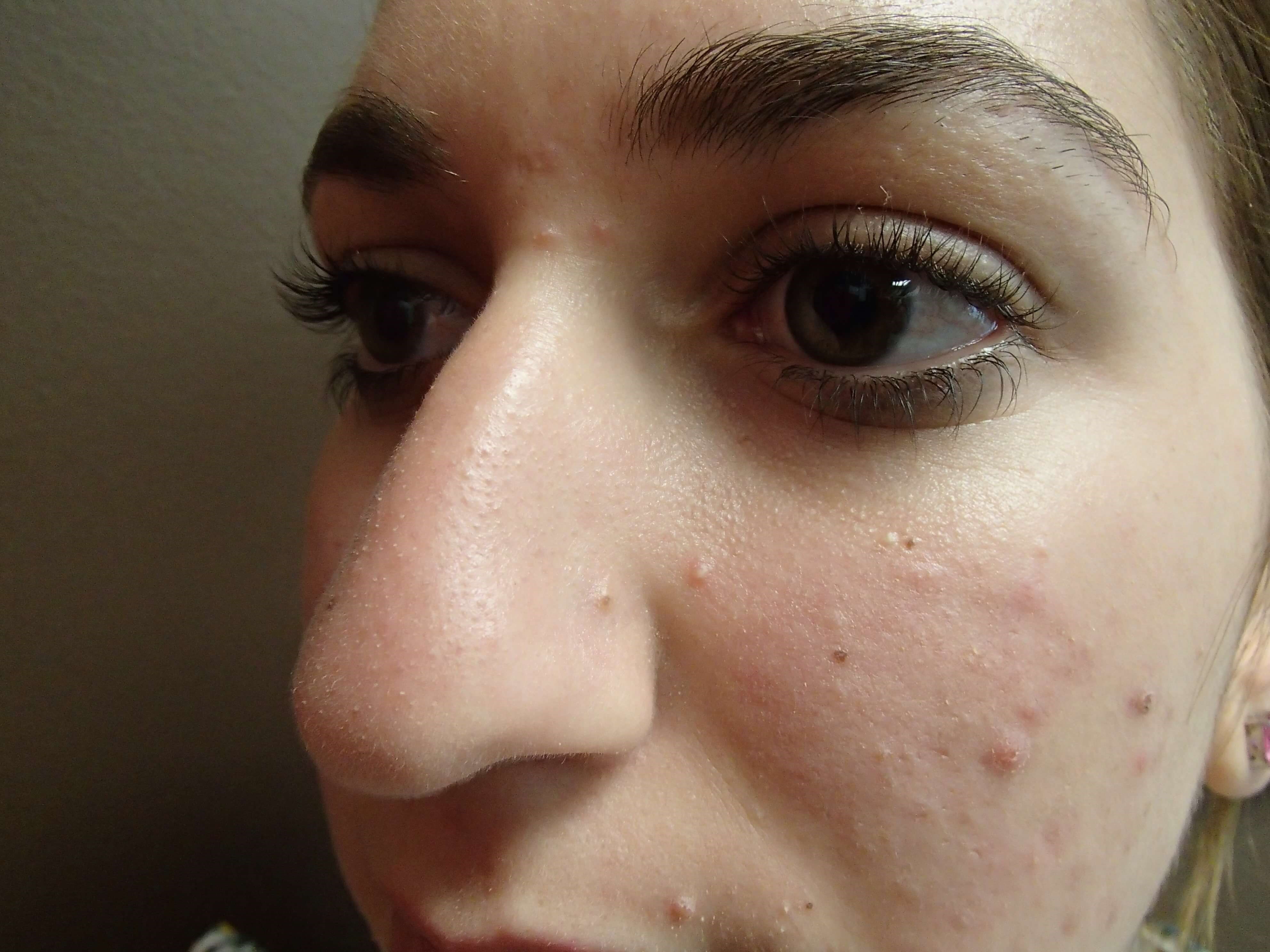 Rhinoplasty Before