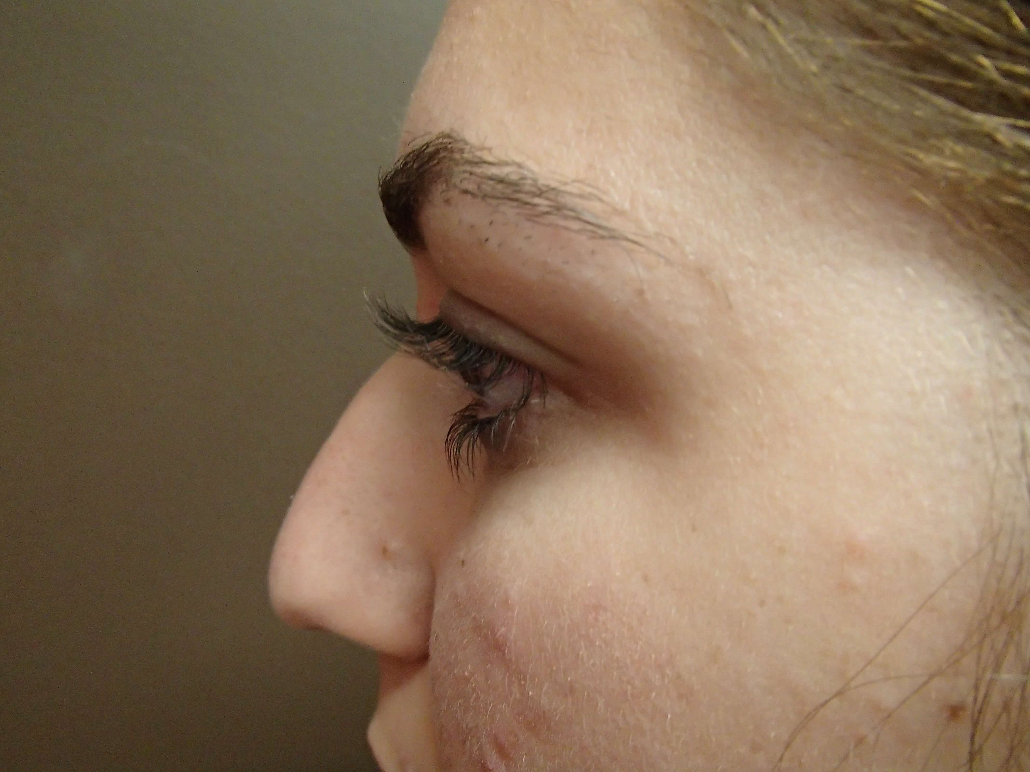 Rhinoplasty Before