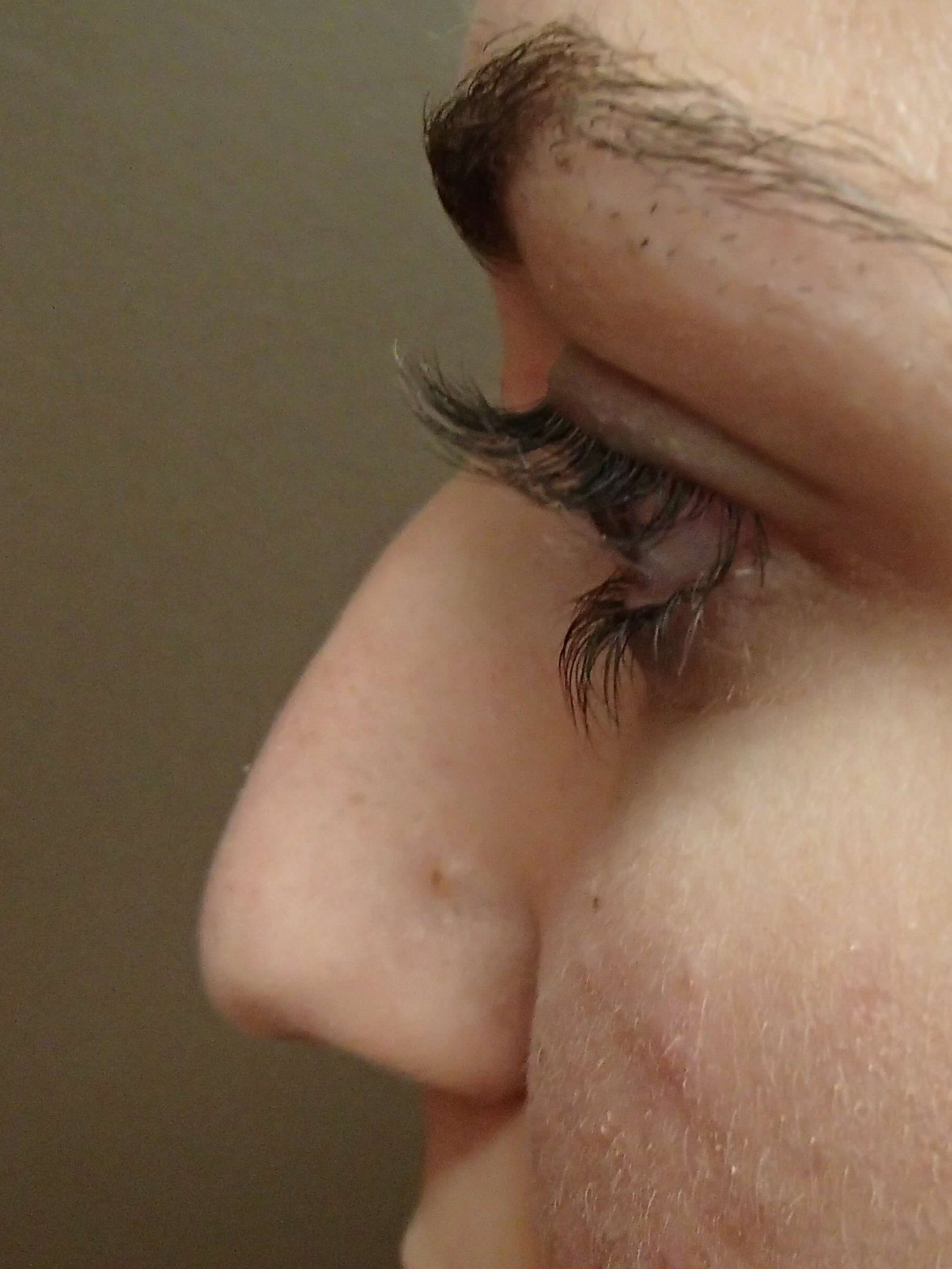 Rhinoplasty Before
