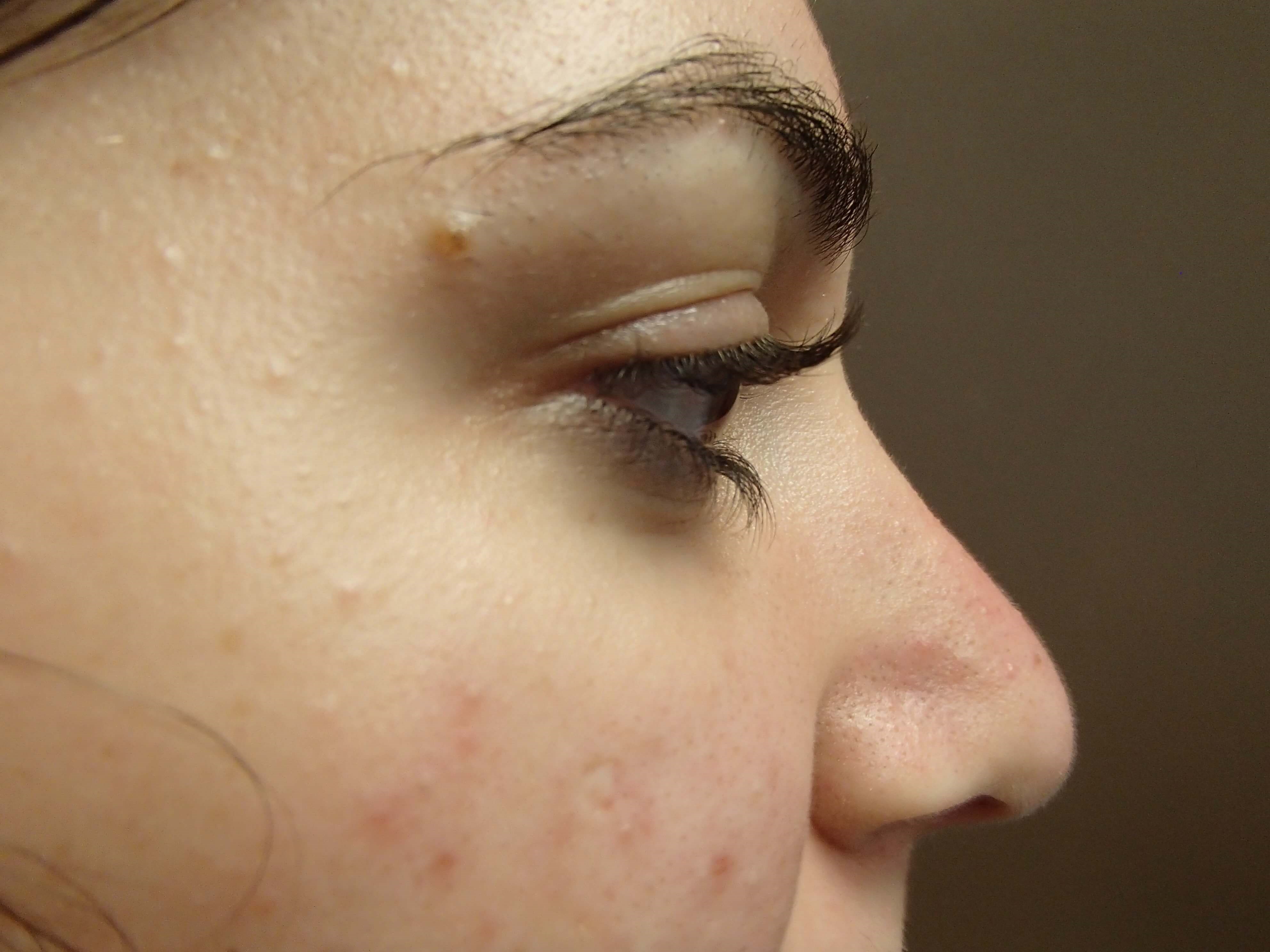 Rhinoplasty After