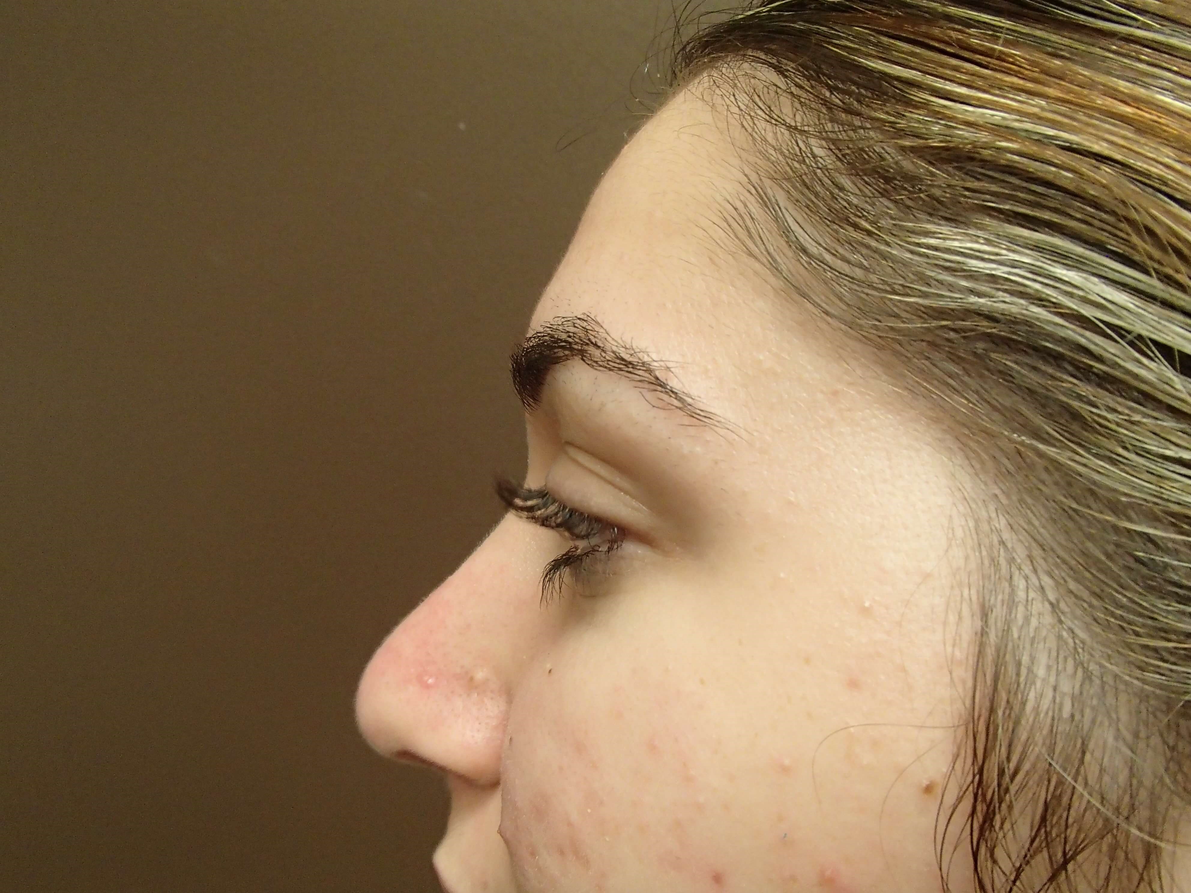 Rhinoplasty After