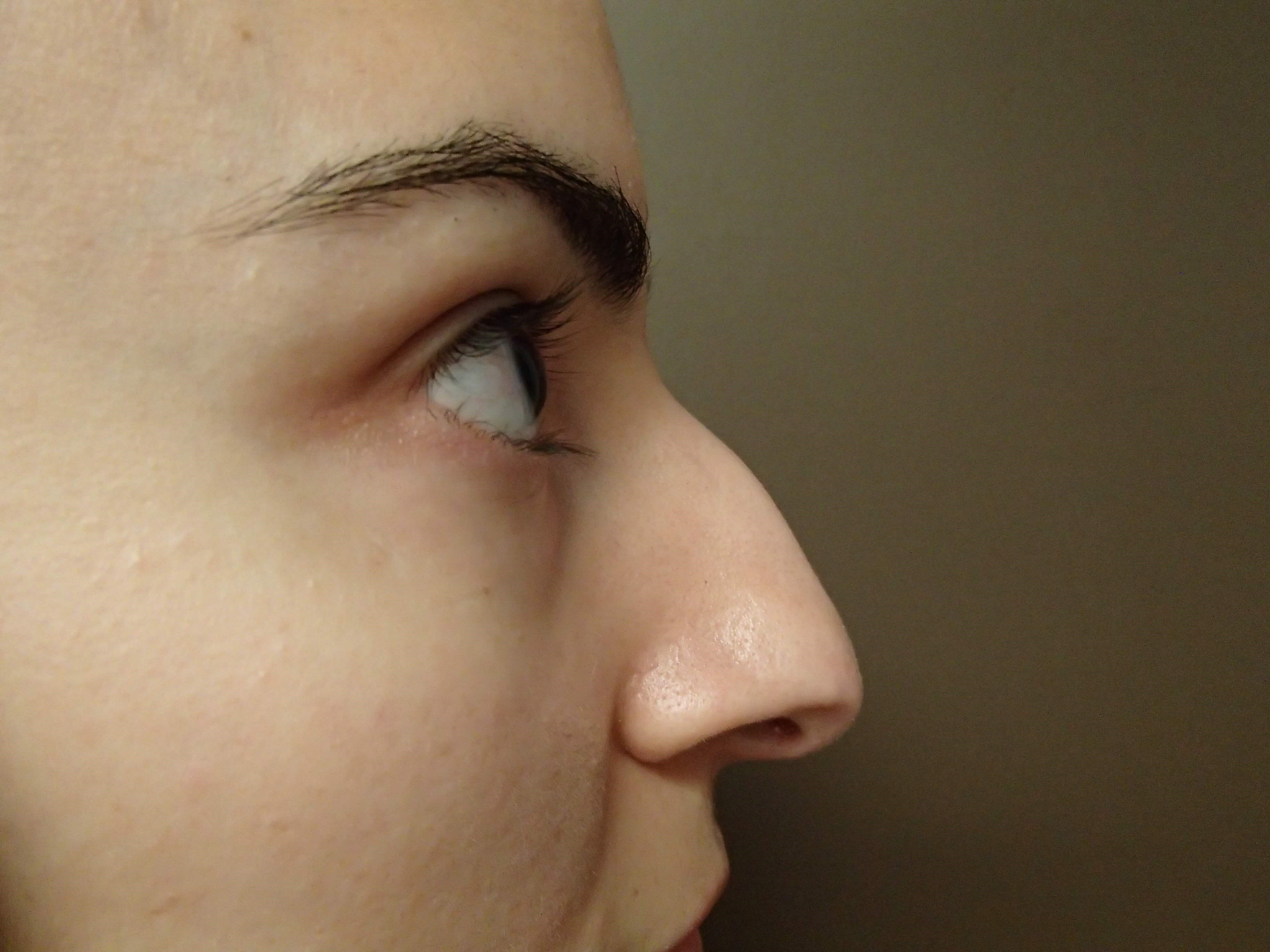 Rhinoplasty Before