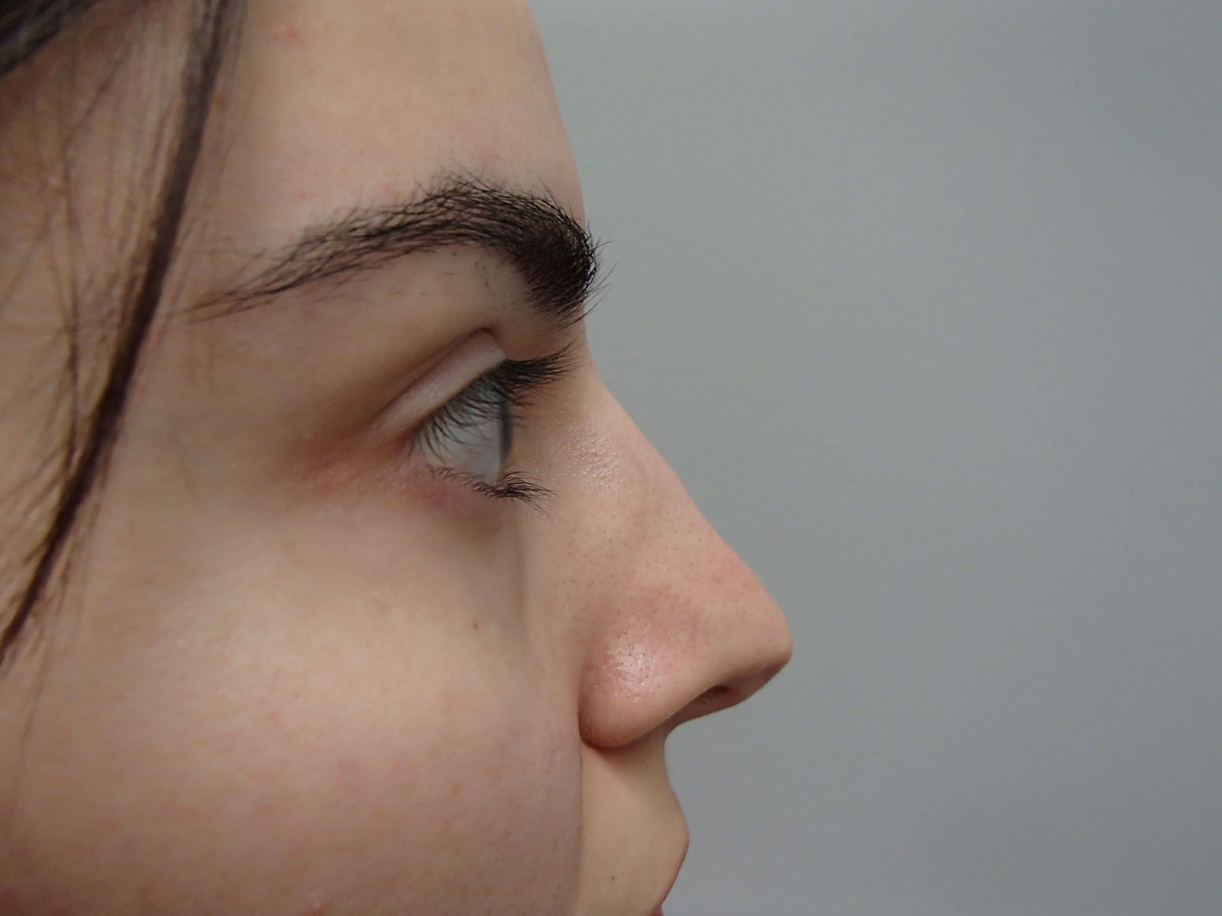 Rhinoplasty After
