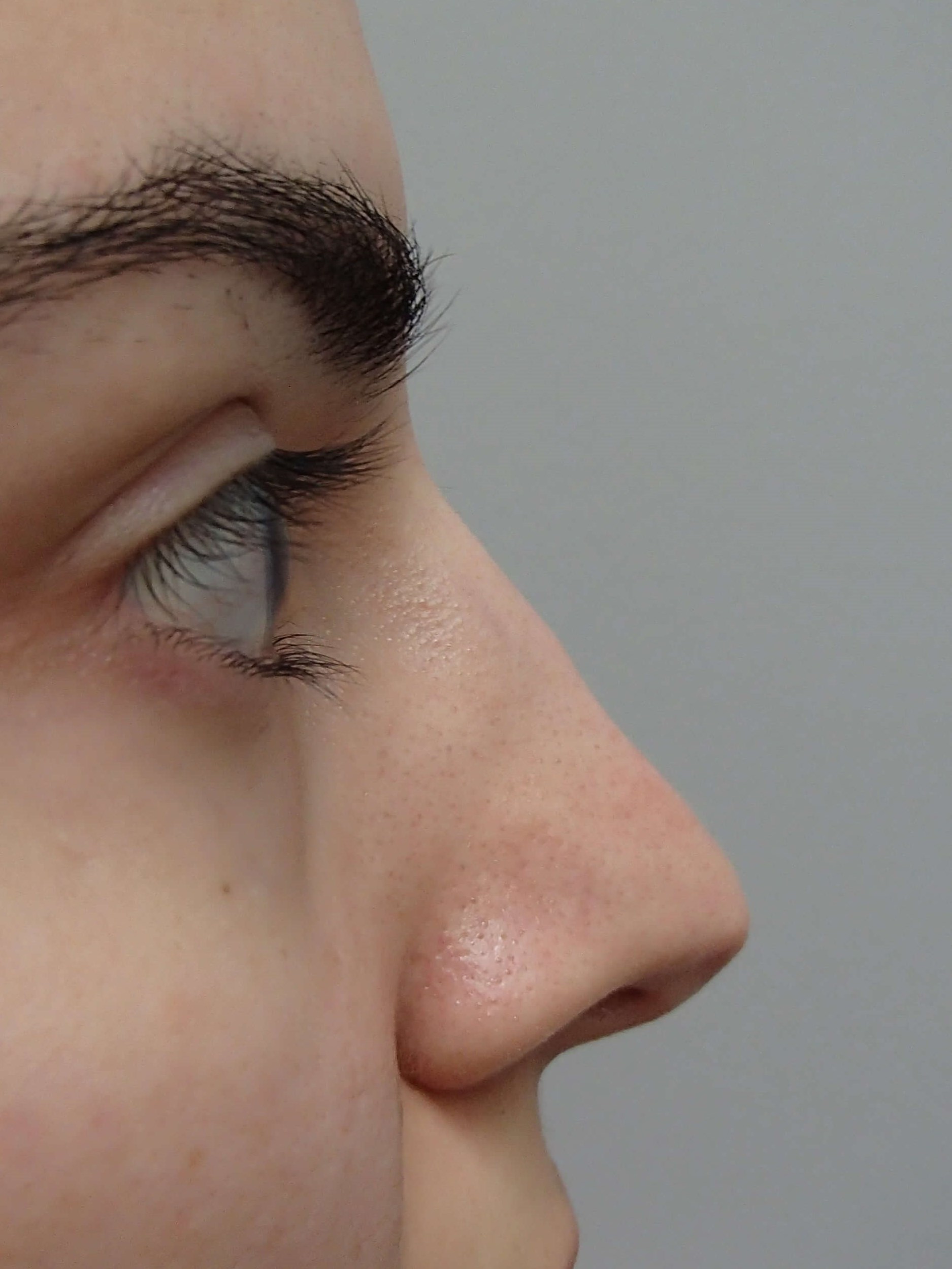 Rhinoplasty After