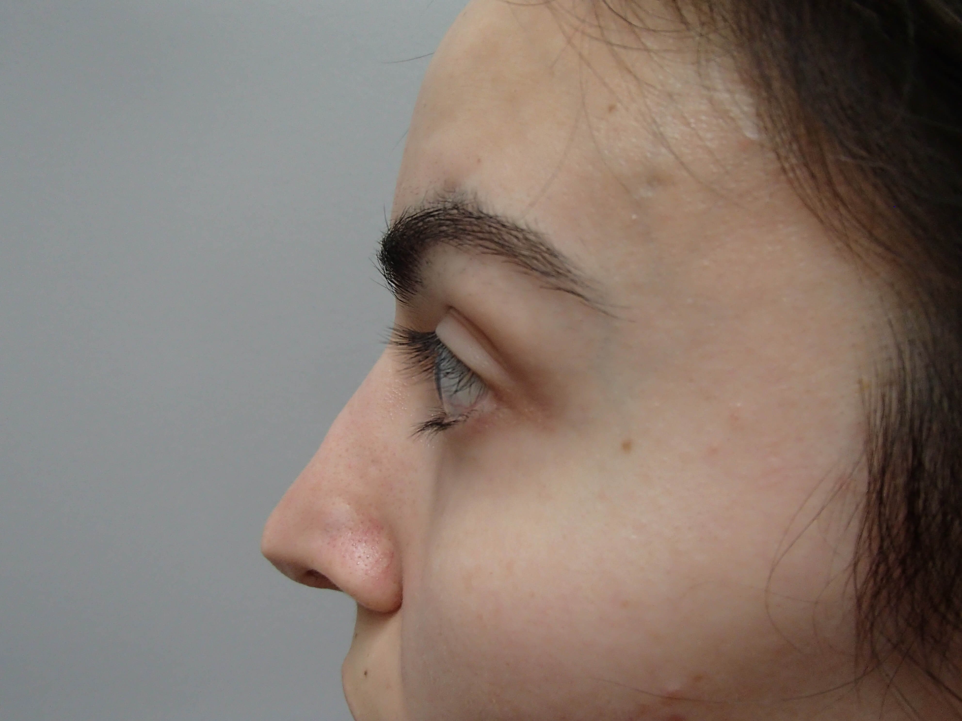 Rhinoplasty After