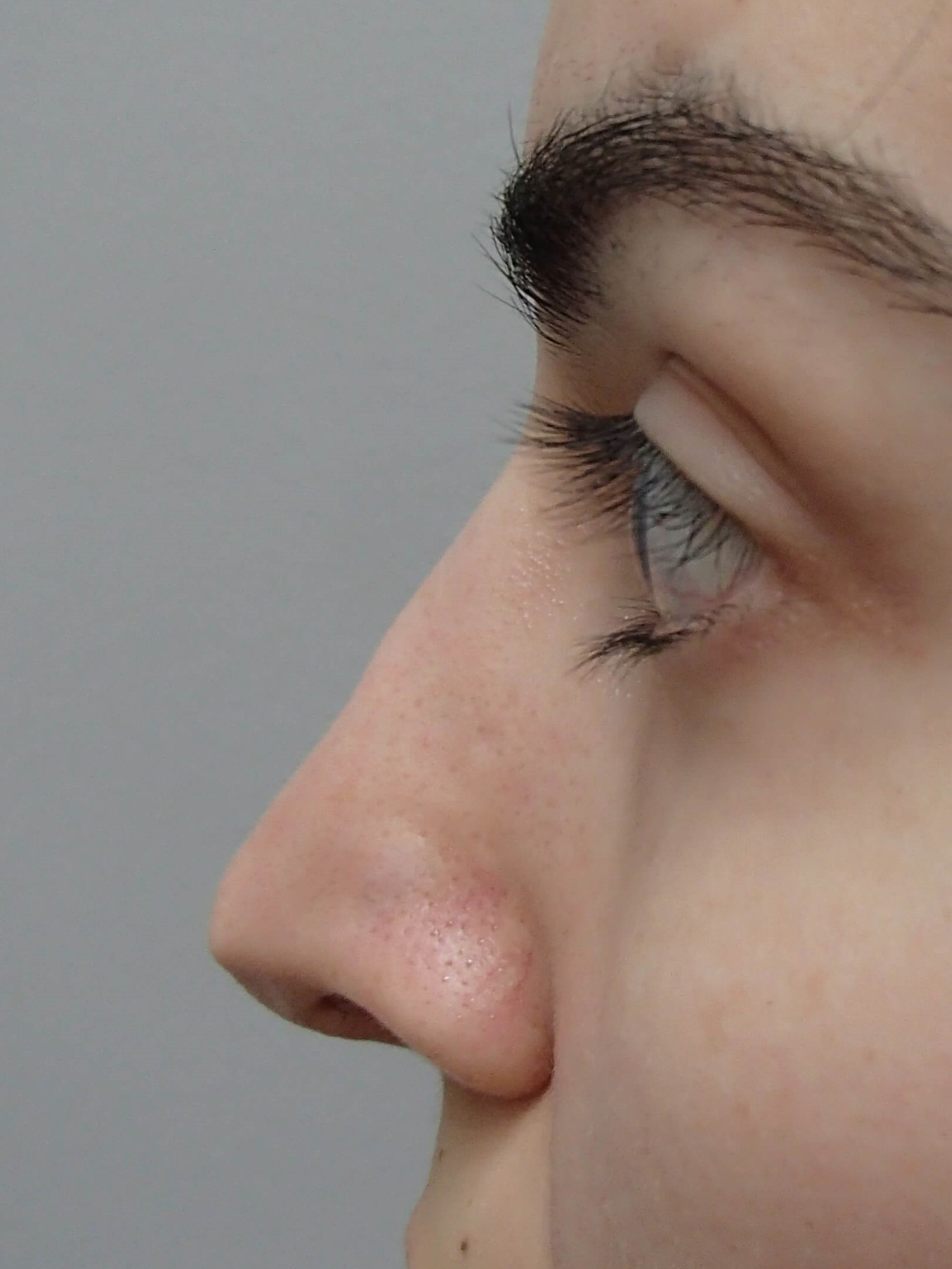 Rhinoplasty After