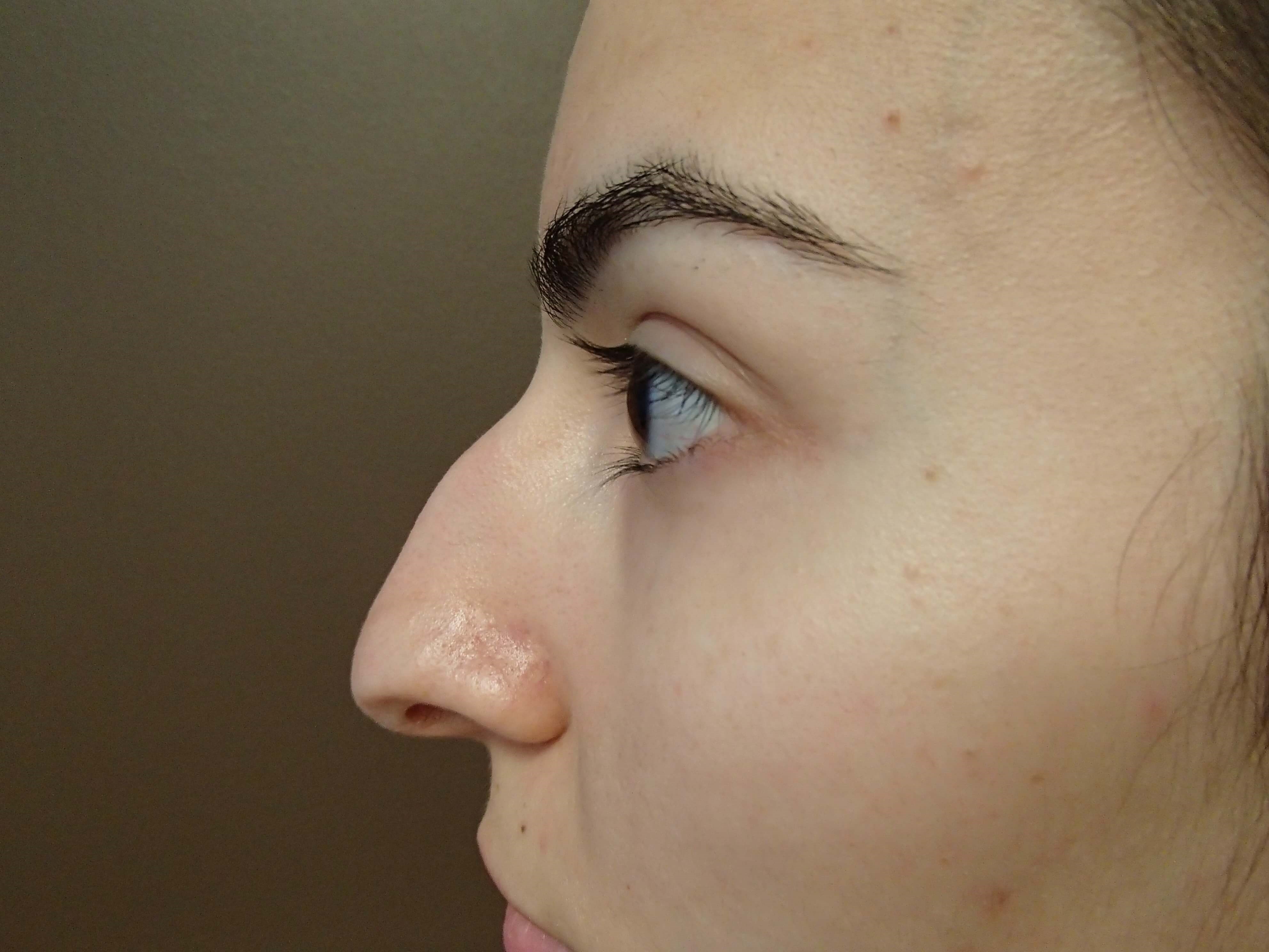 Rhinoplasty Before