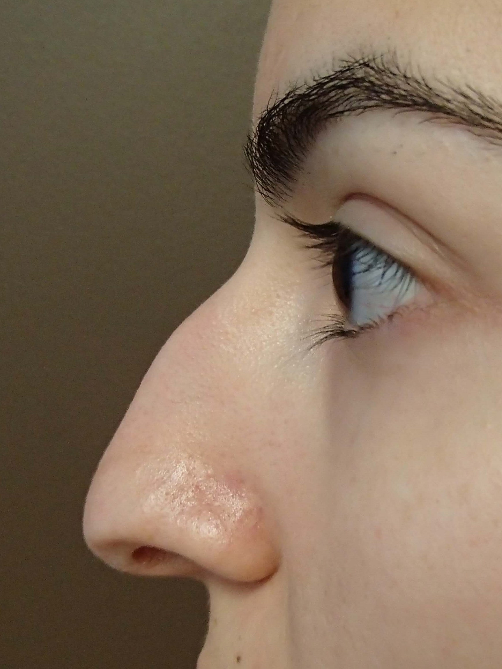 Rhinoplasty Before