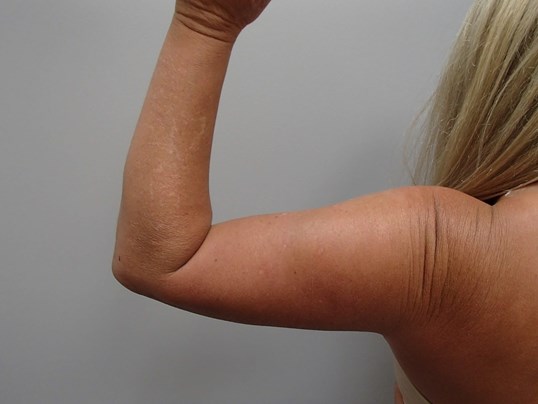 Brachioplasty (Arm Lift) After