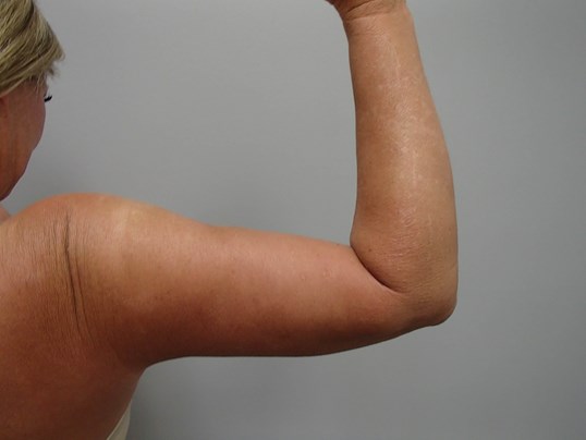Brachioplasty (Arm Lift) After