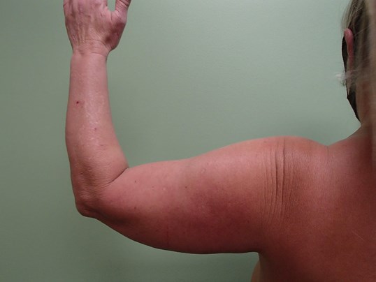 Brachioplasty (Arm Lift) Before