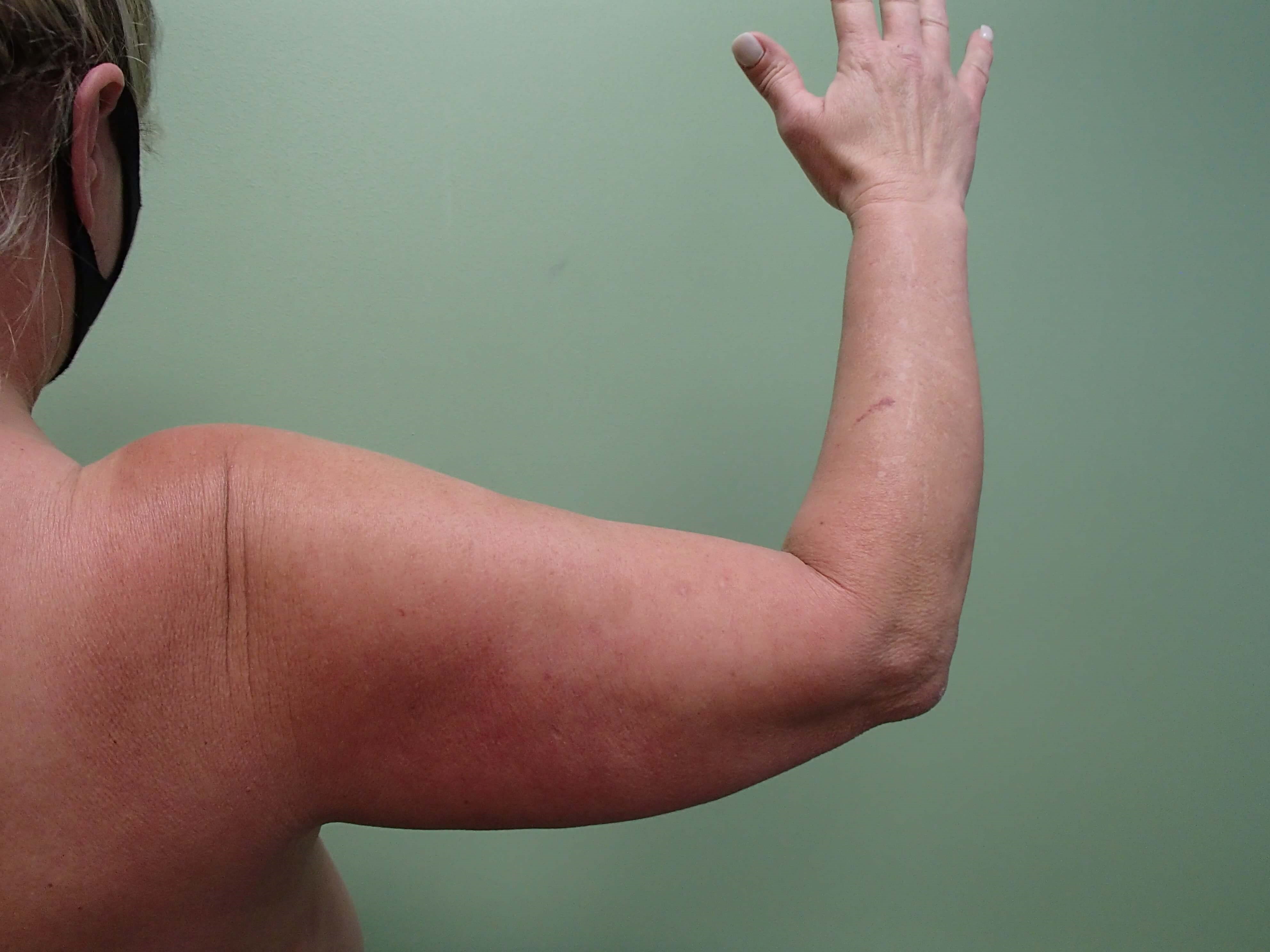 Brachioplasty (Arm Lift) Before