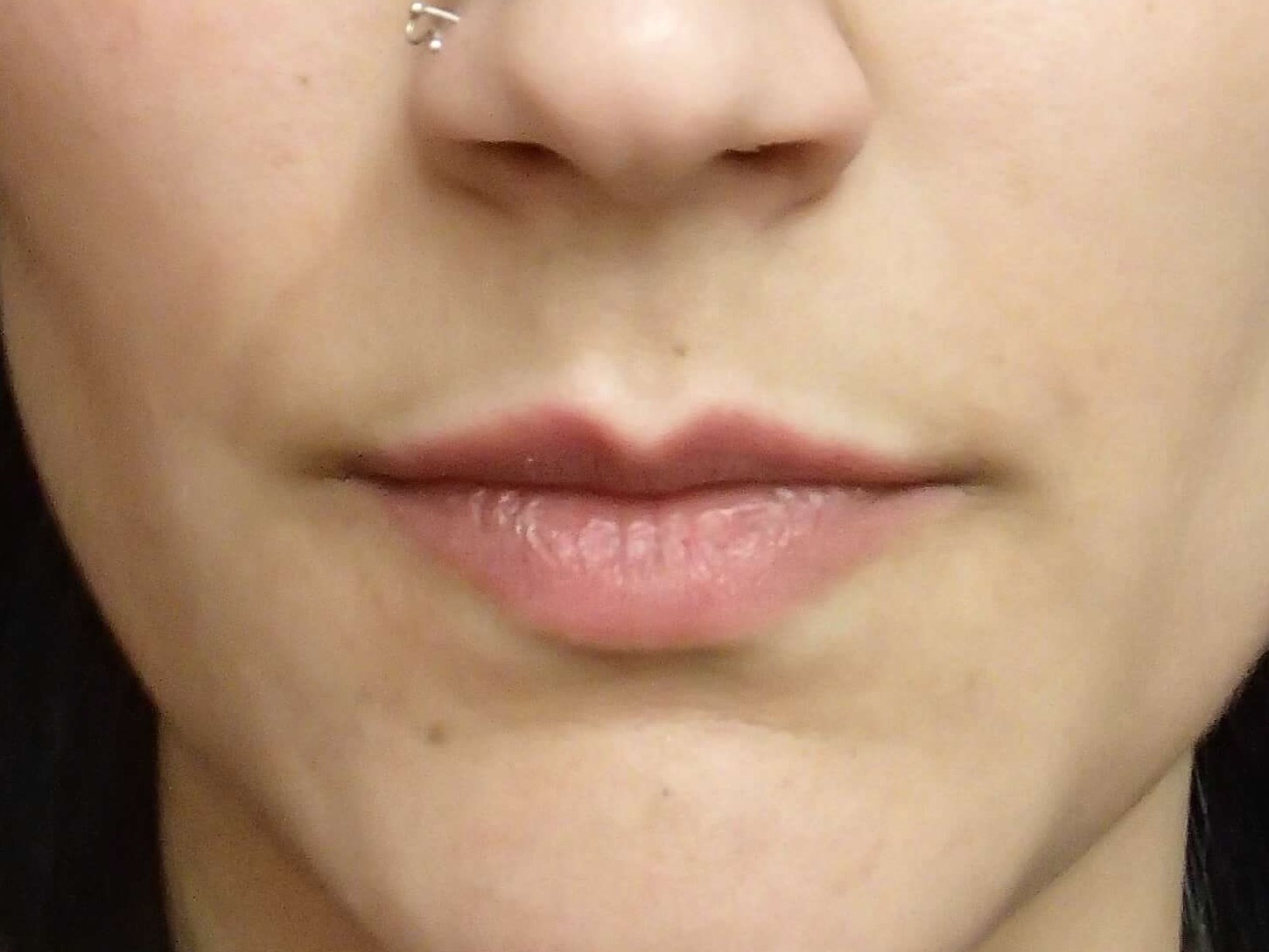 Juvederm to Lips Before
