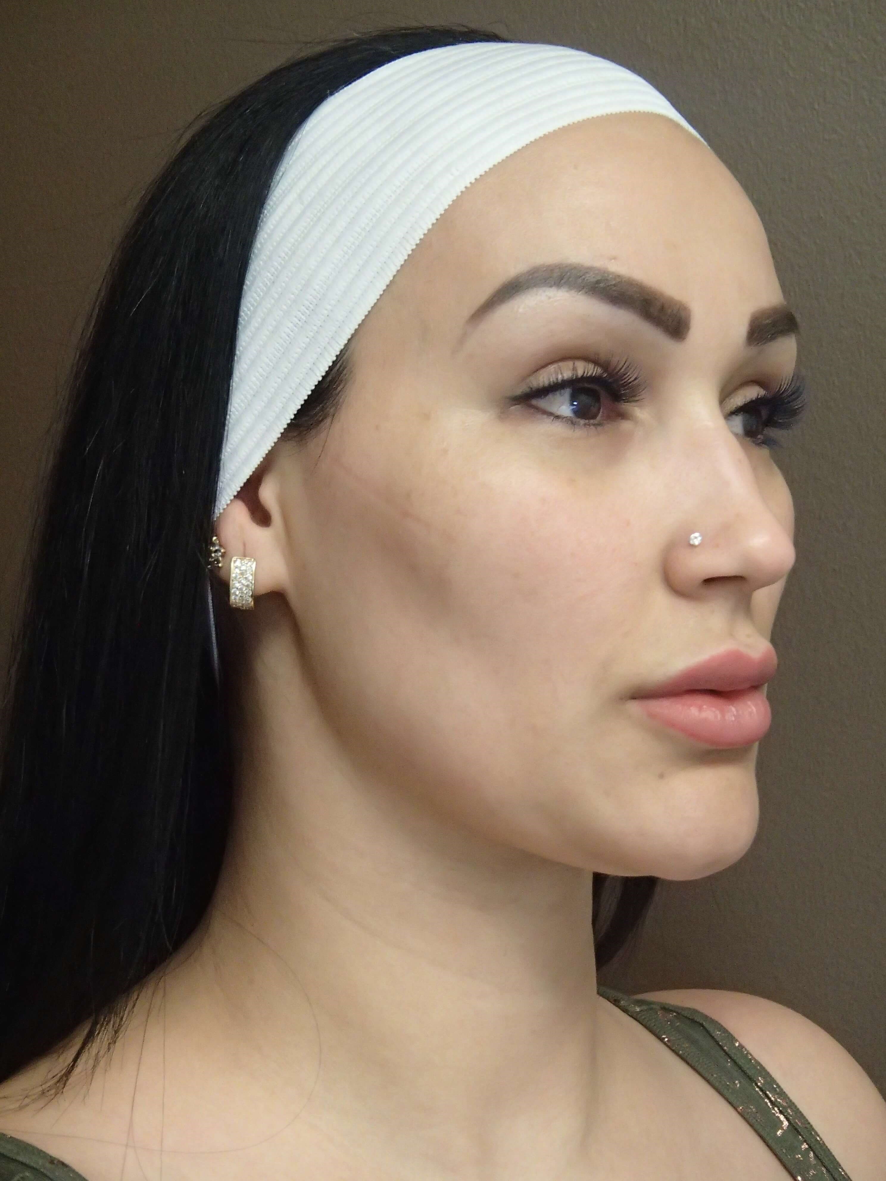 Juvederm to Lips After