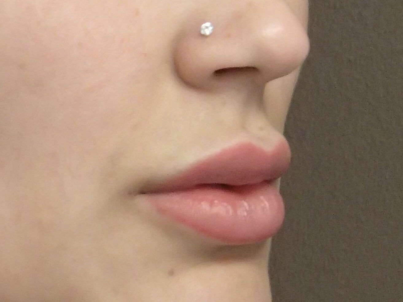 Juvederm to Lips After