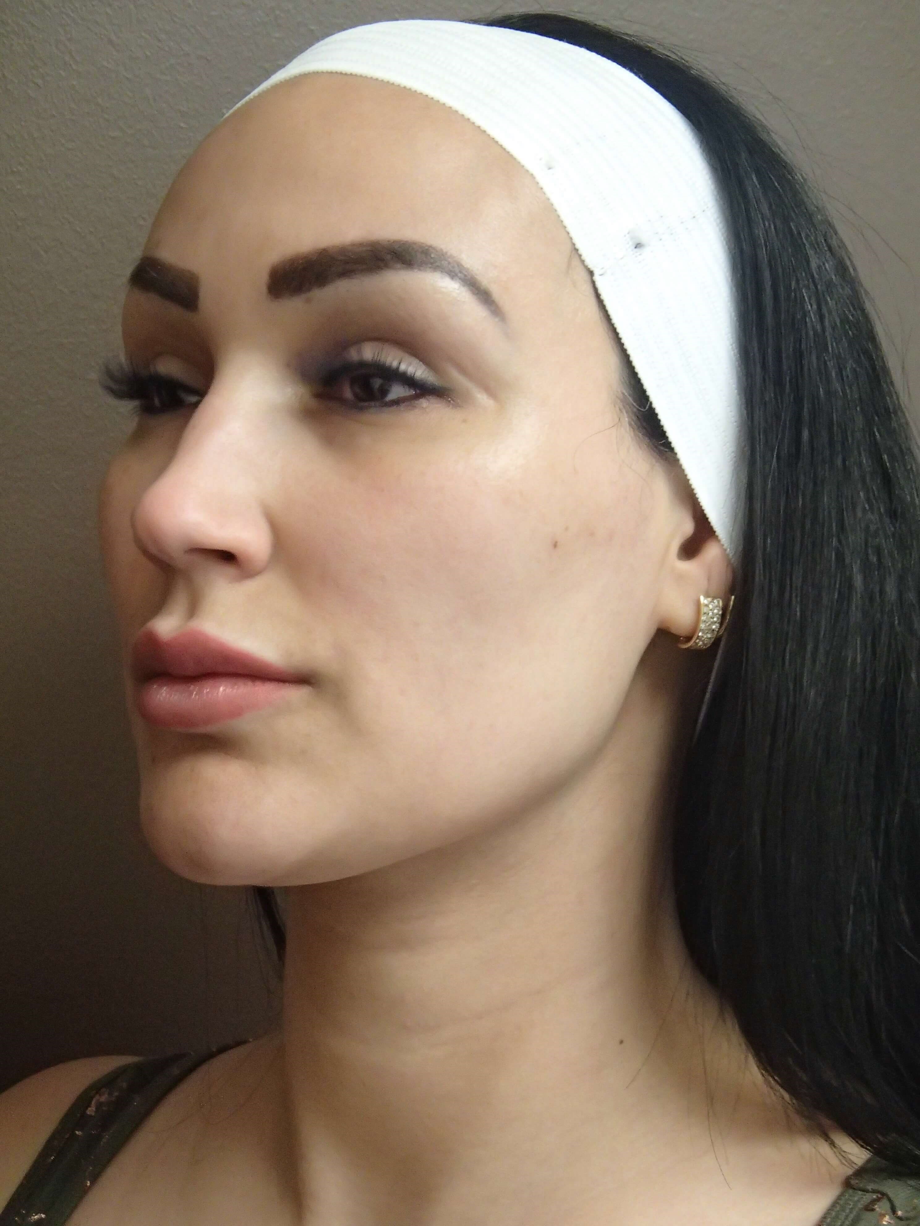 Juvederm to Lips After