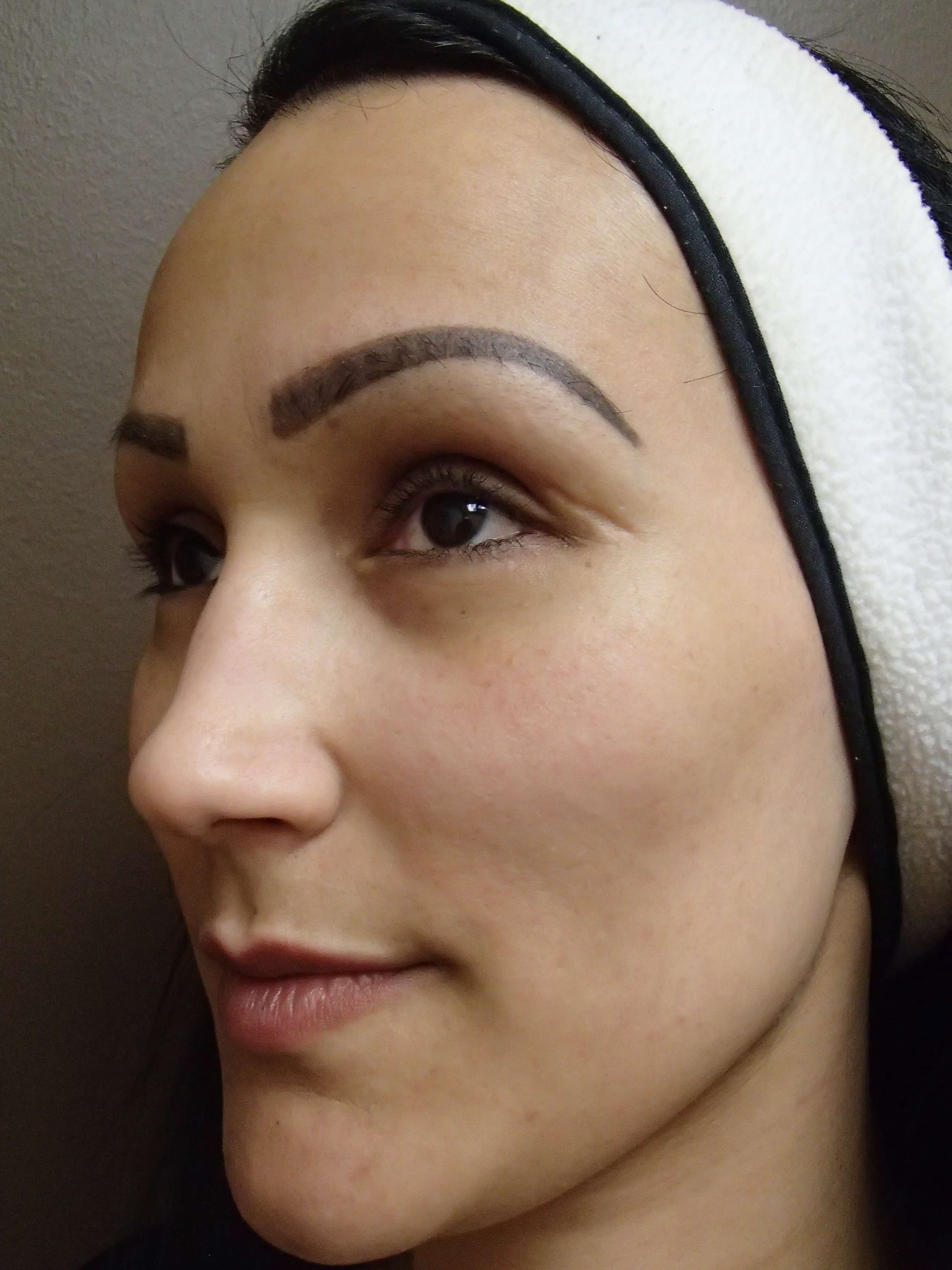 Juvederm to Lips Before