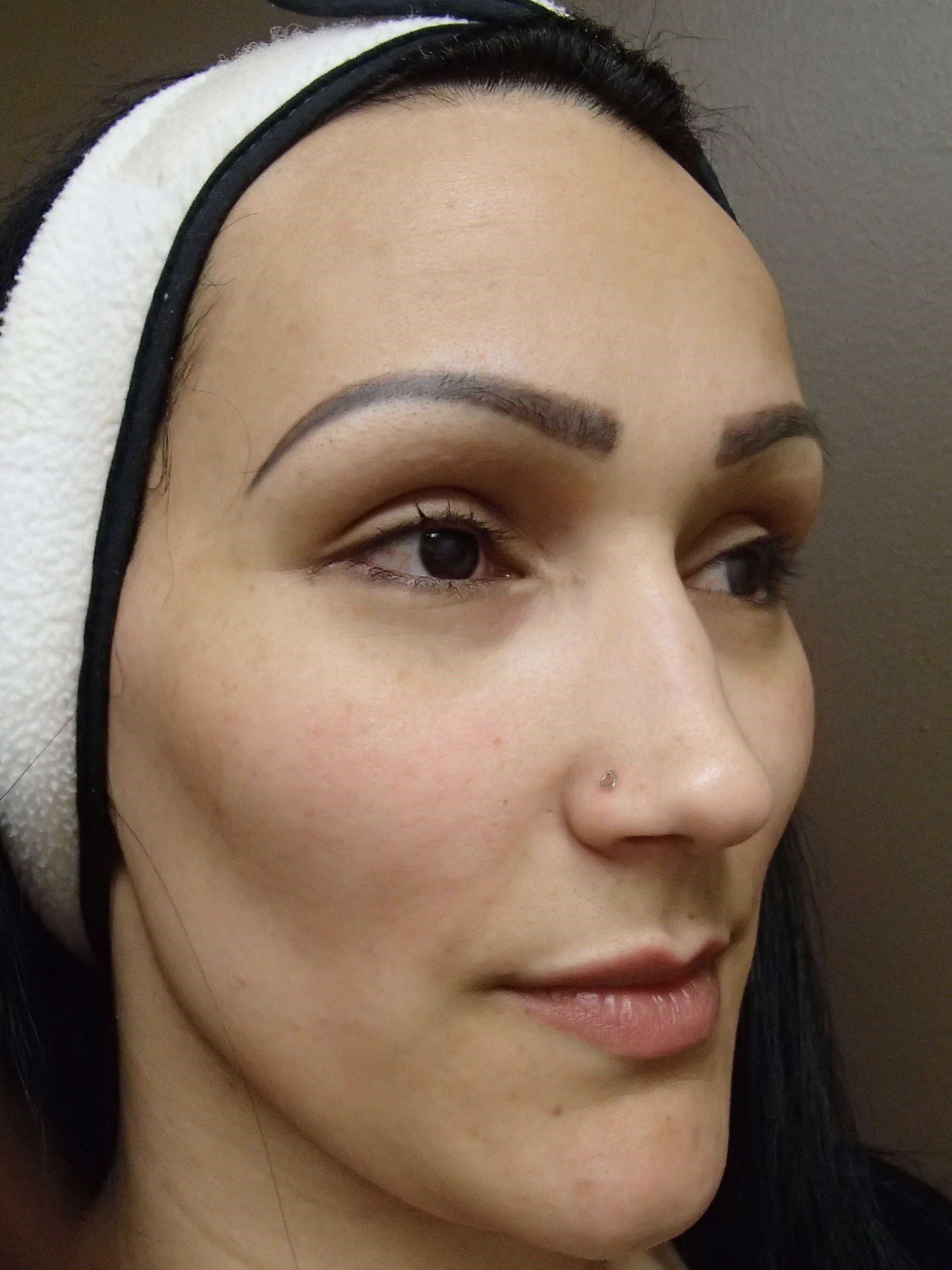 Juvederm to Lips Before
