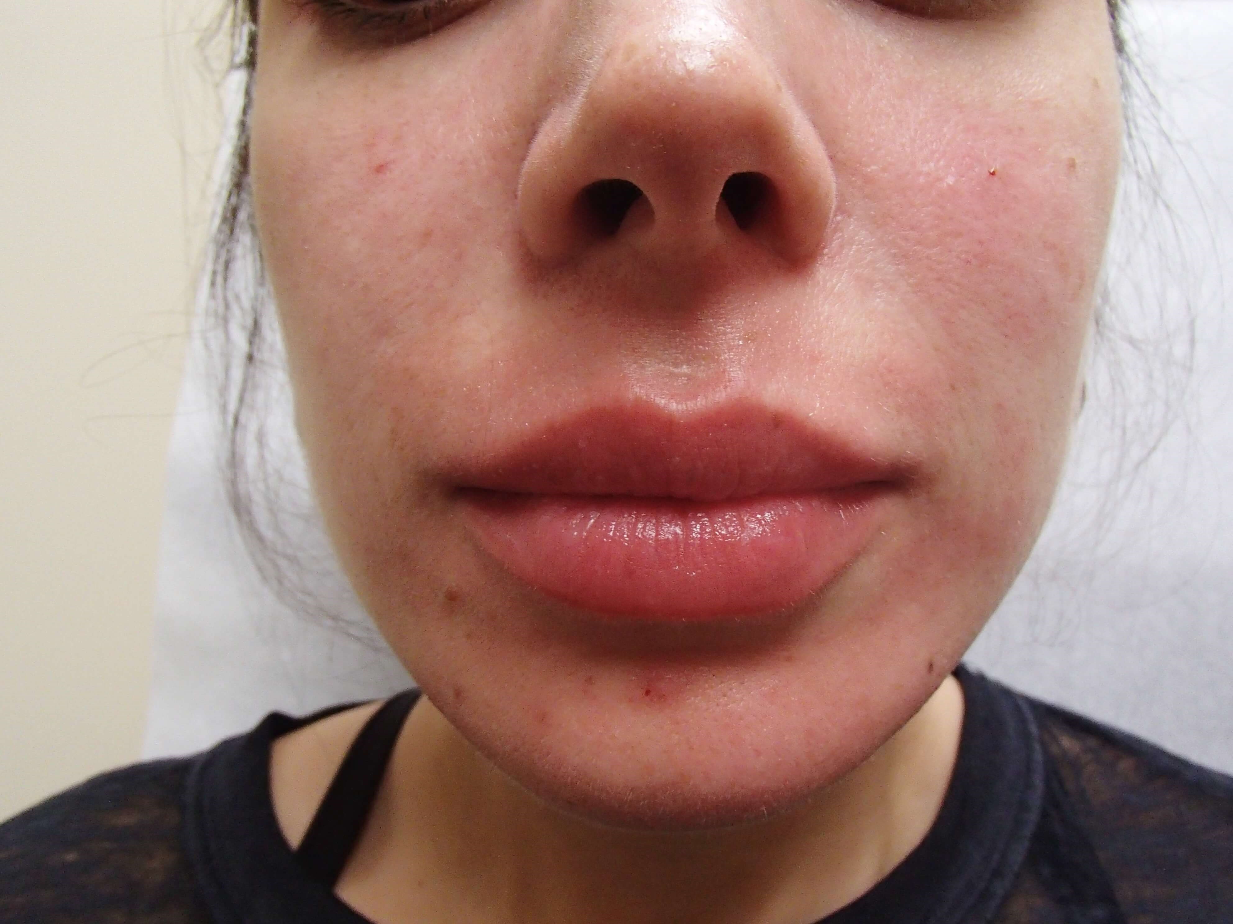 Juvederm After