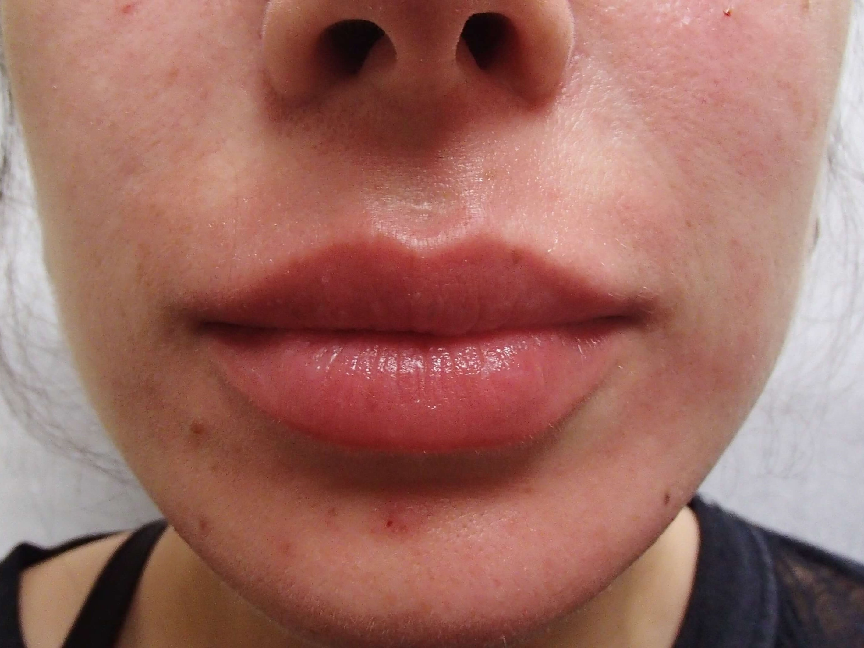 Juvederm After