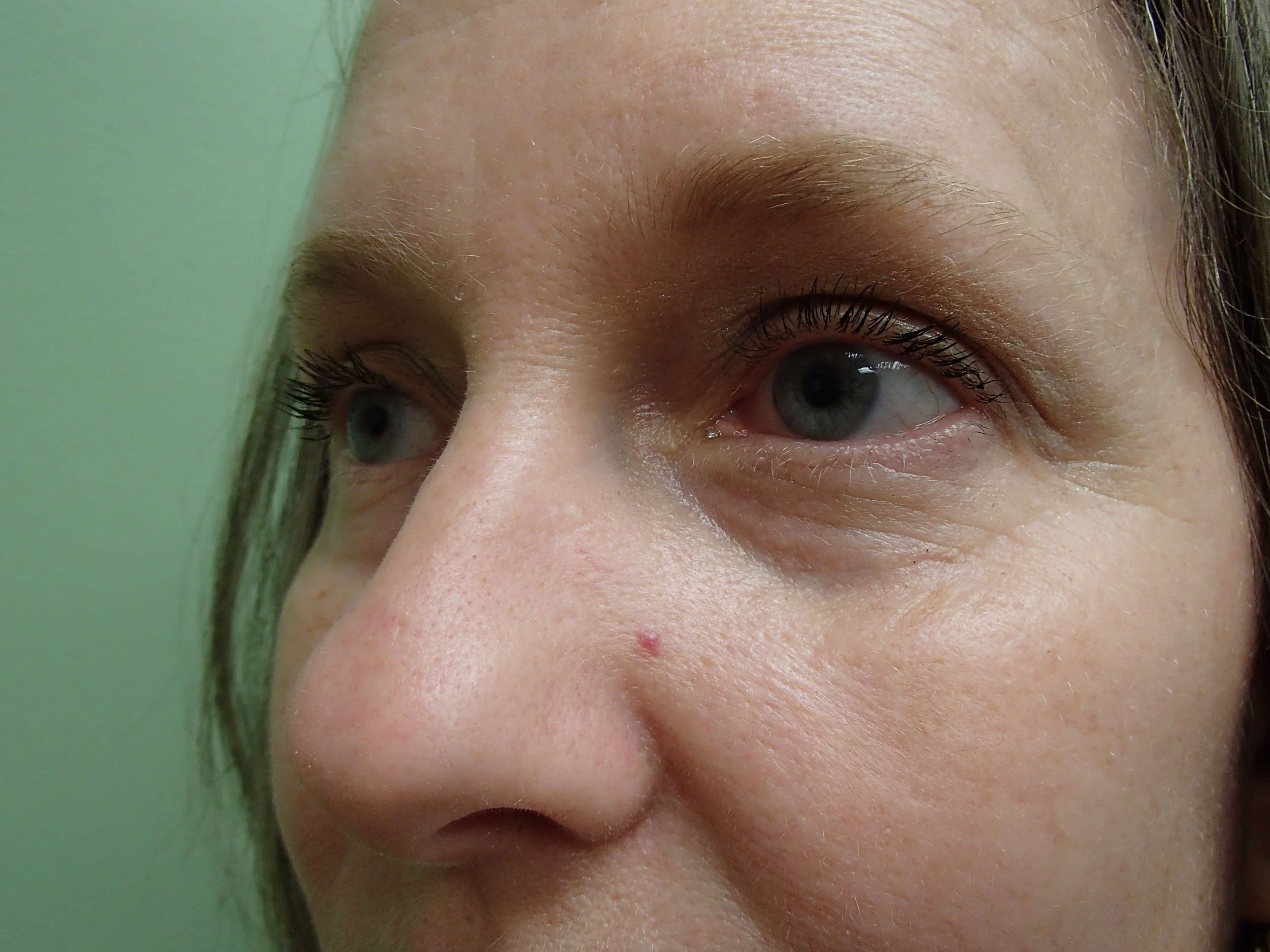 Rhinoplasty Before