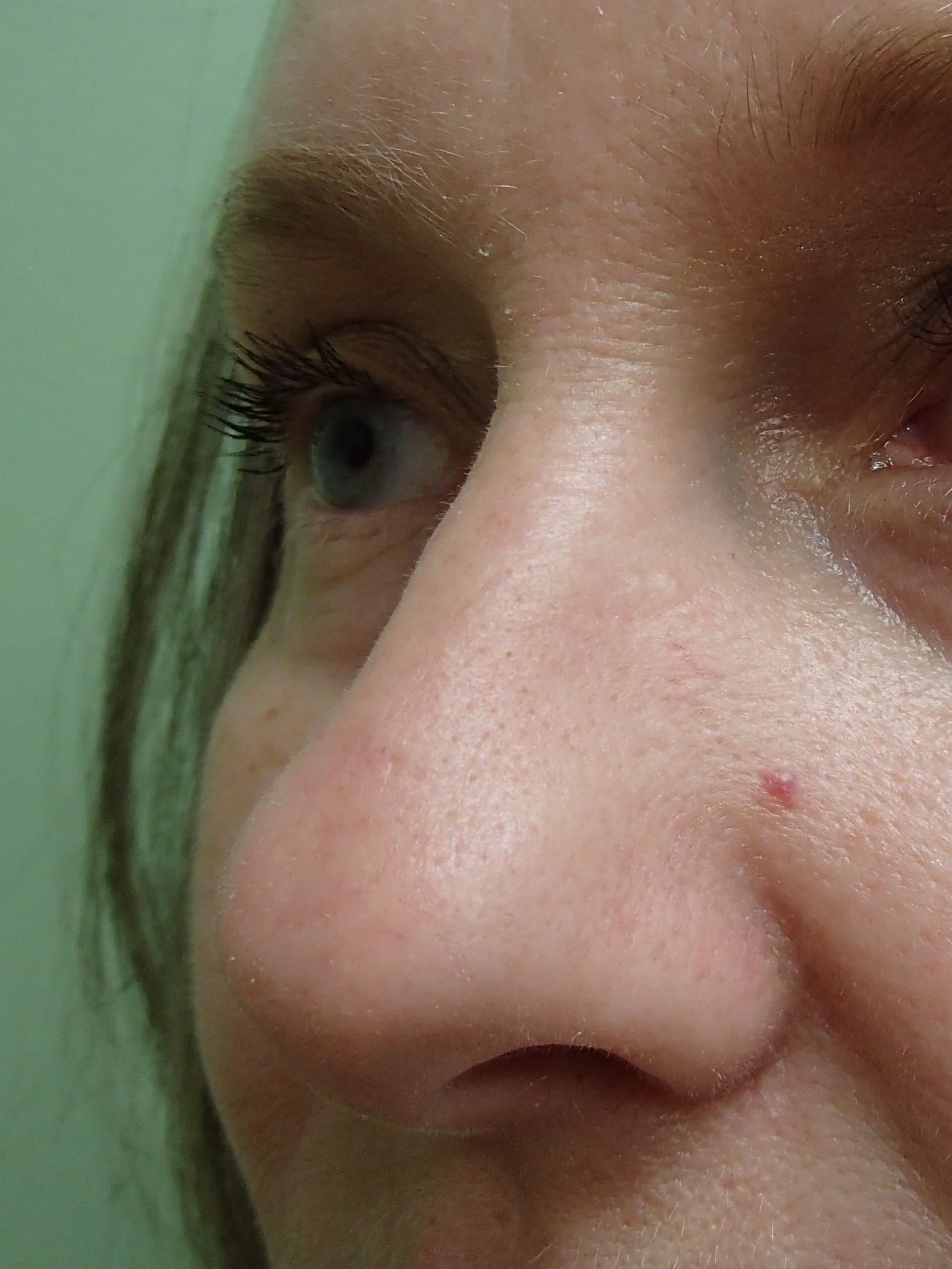 Rhinoplasty Before
