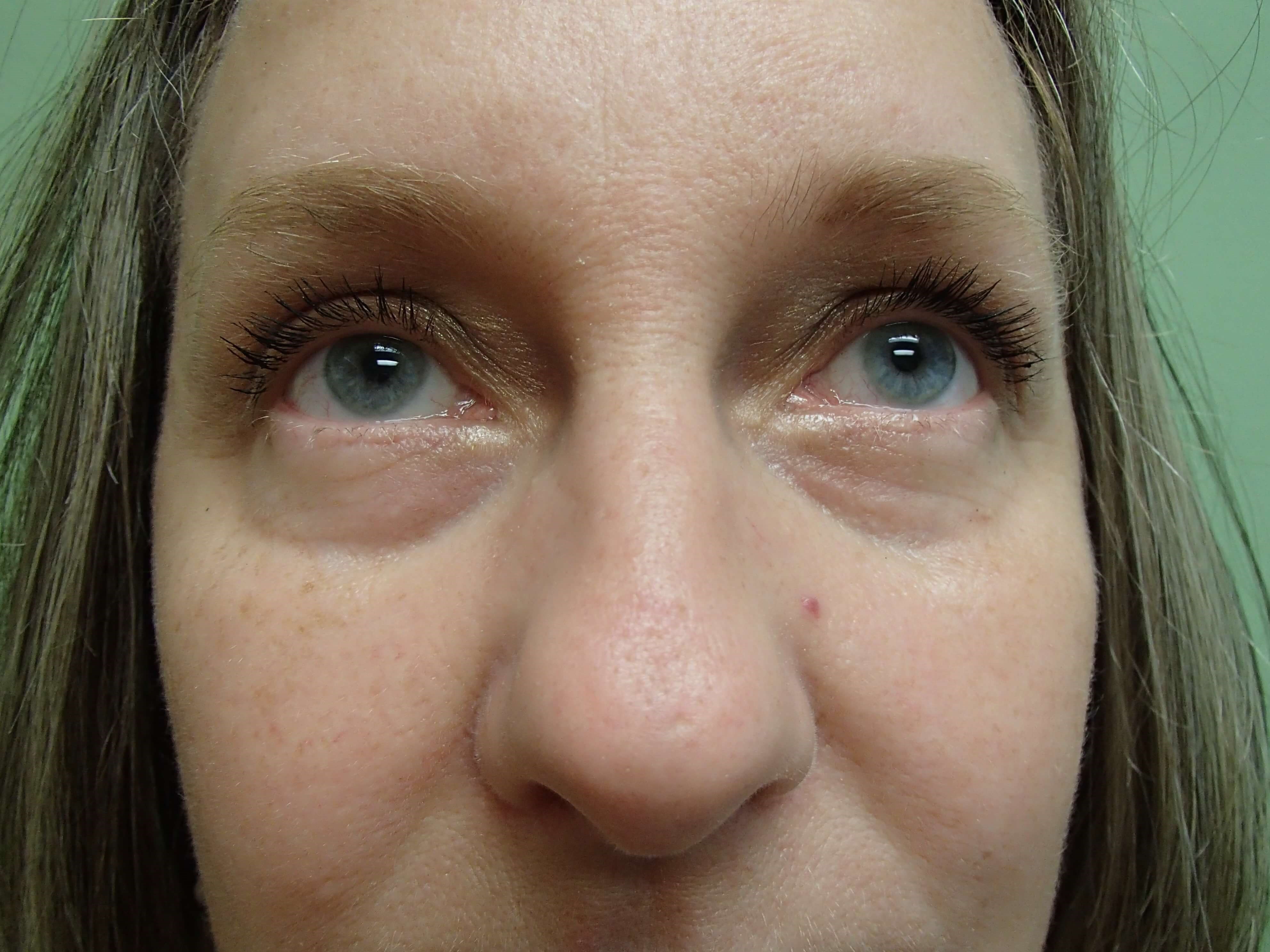Rhinoplasty Before