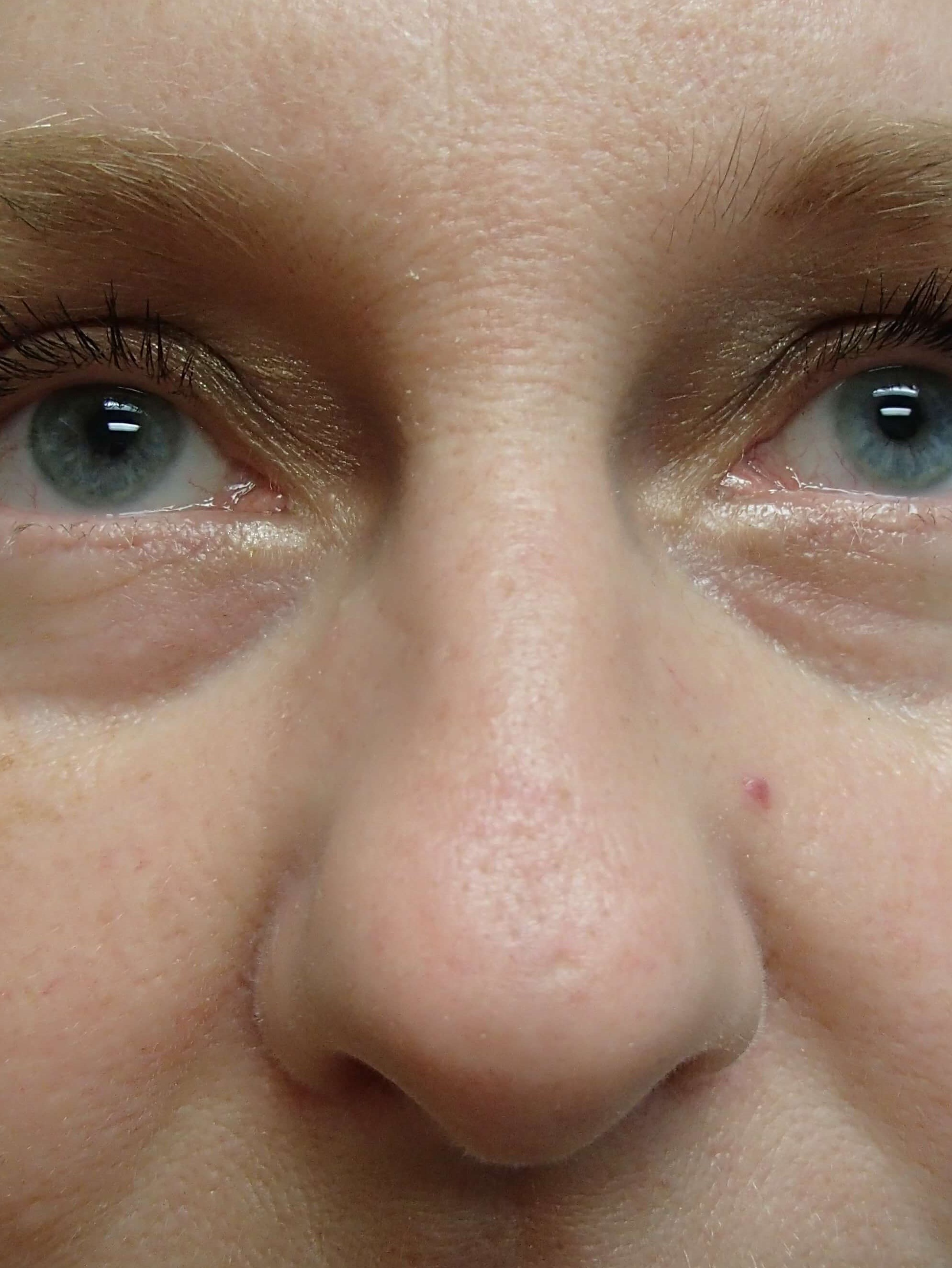 Rhinoplasty Before
