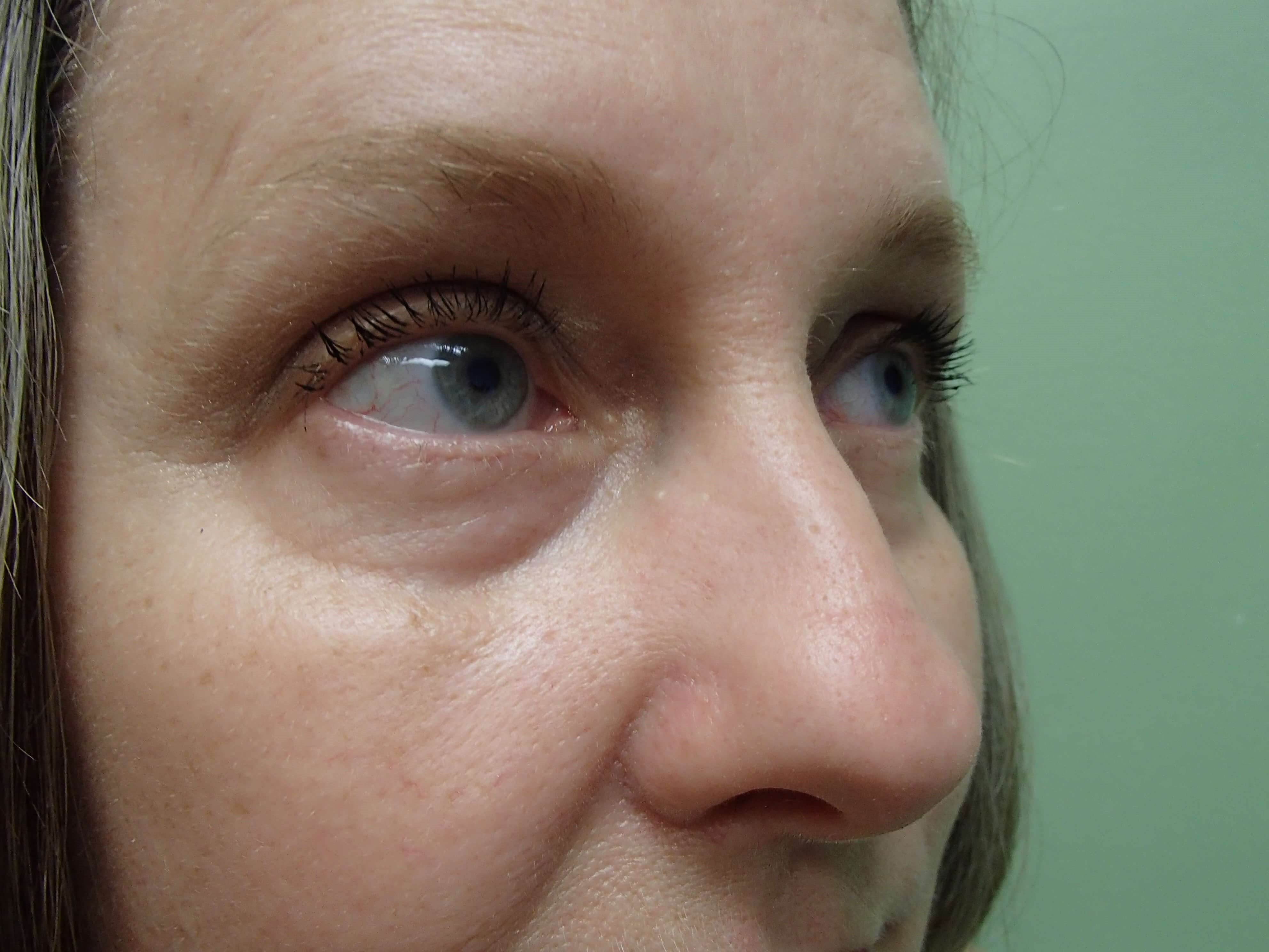 Rhinoplasty Before