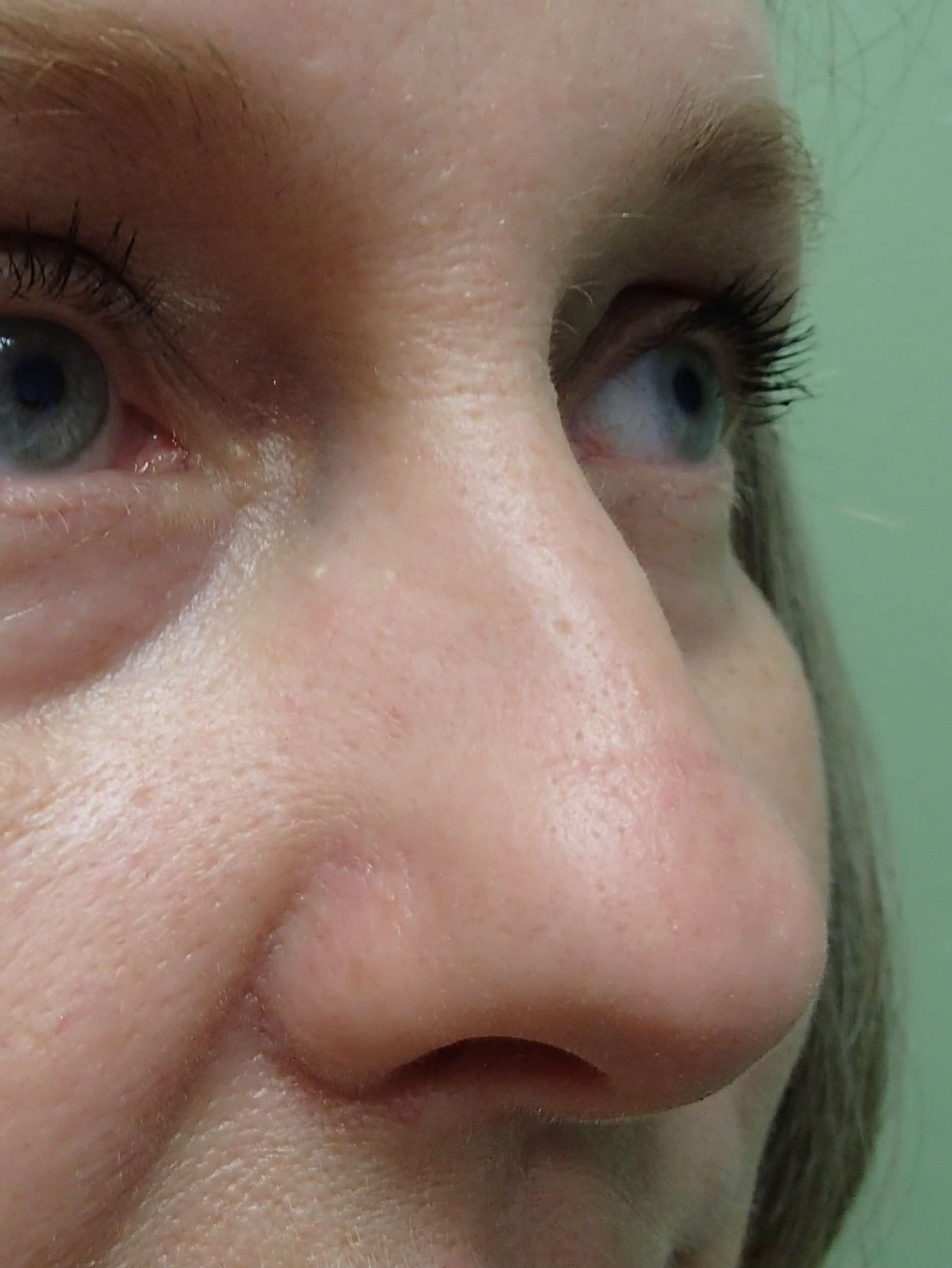 Rhinoplasty Before