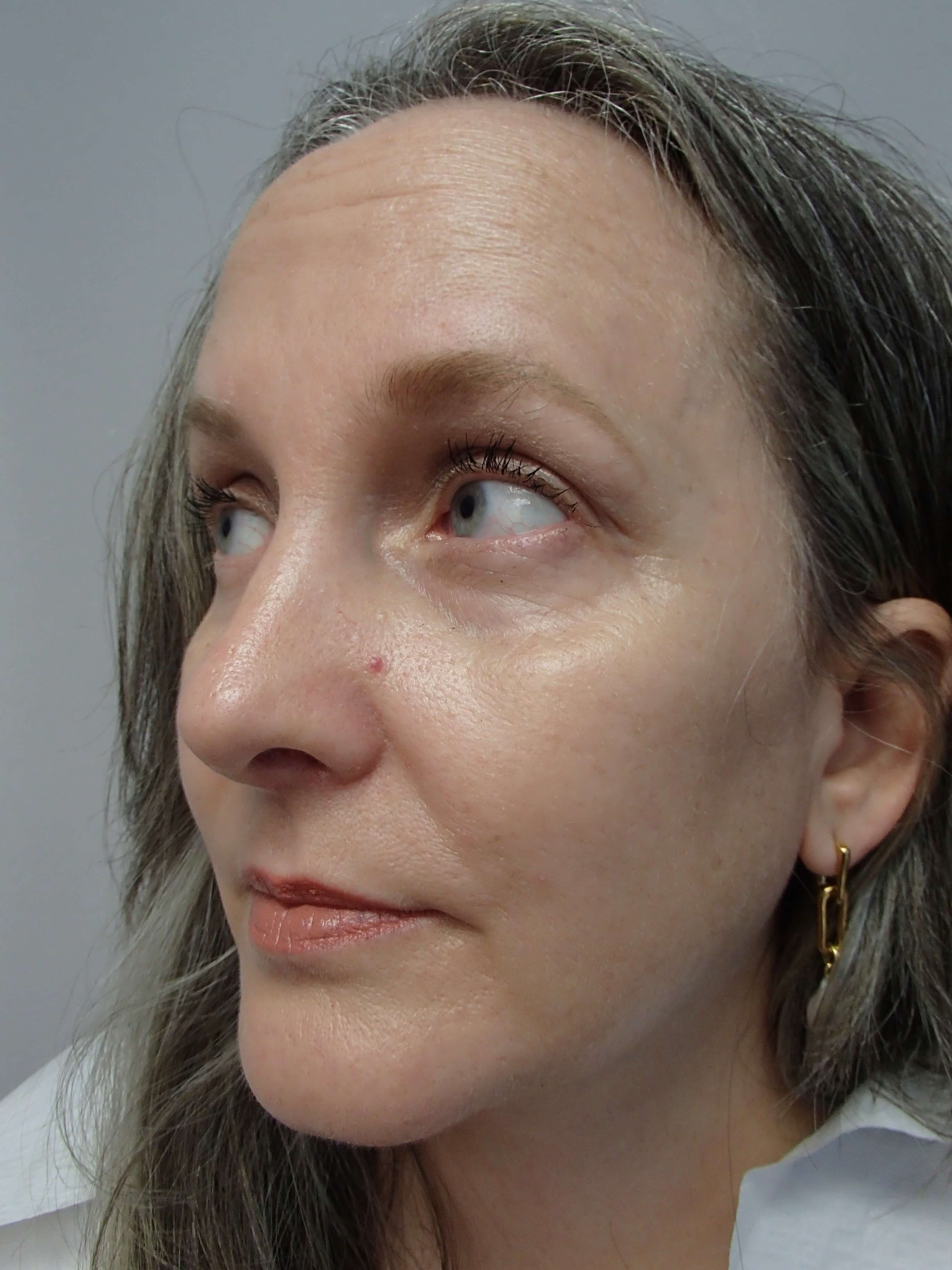 Rhinoplasty After