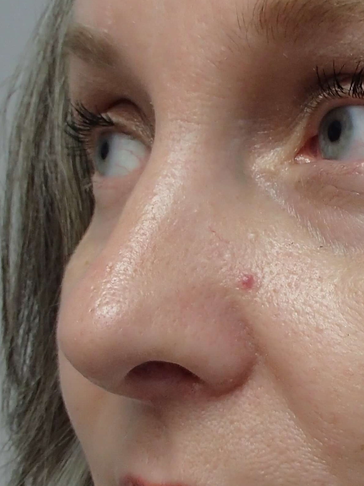 Rhinoplasty After