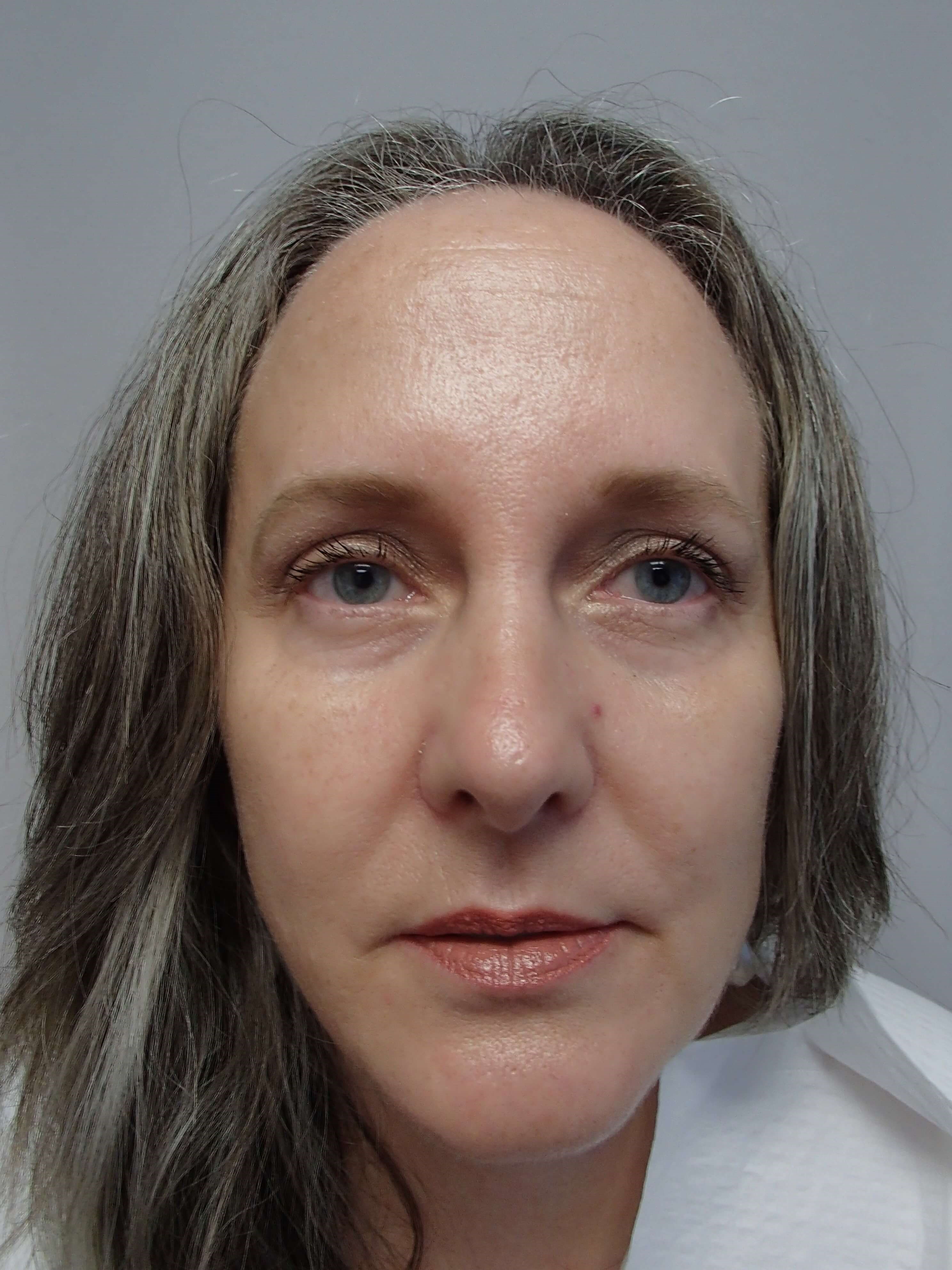 Rhinoplasty After