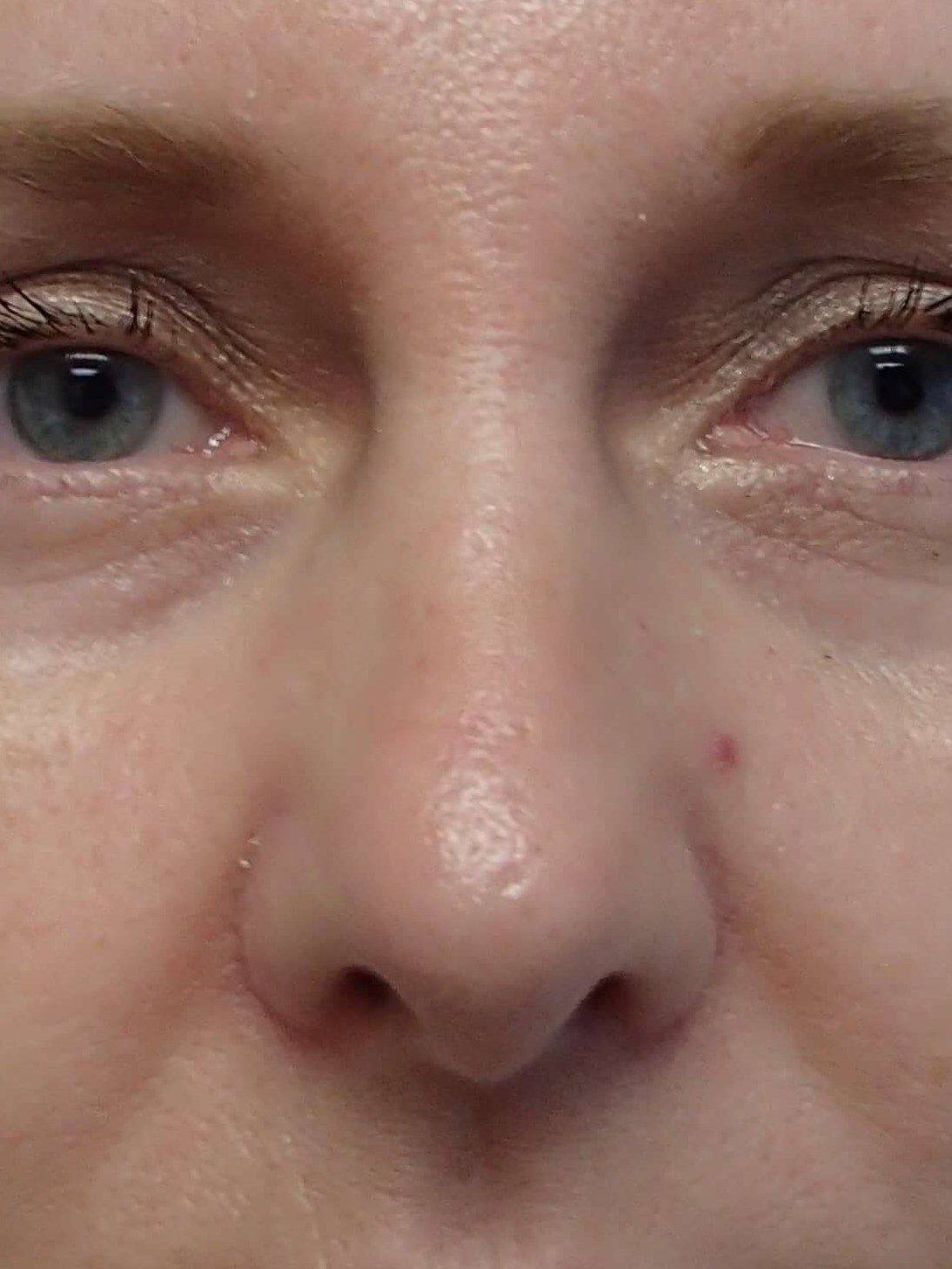 Rhinoplasty After