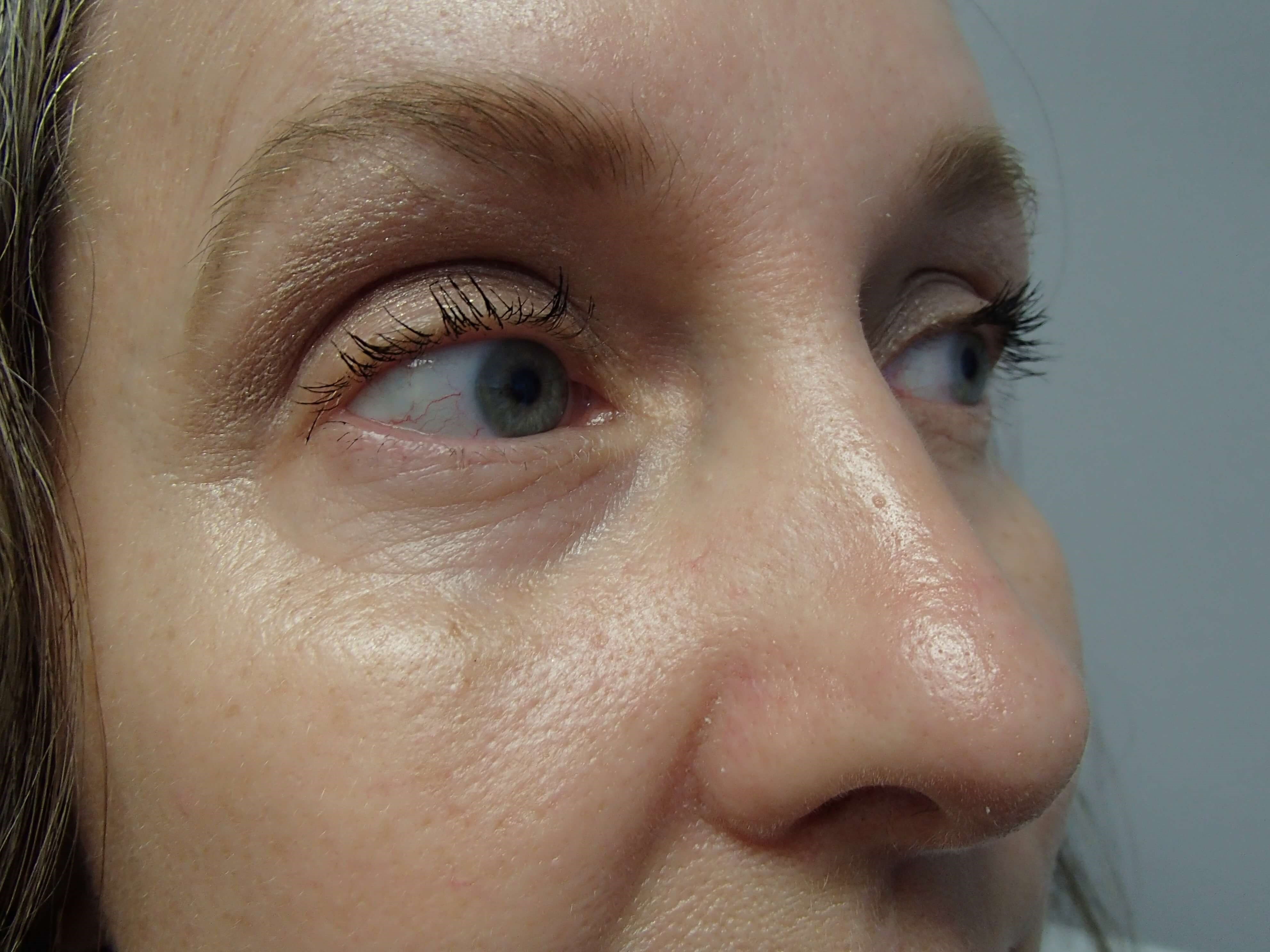 Rhinoplasty After