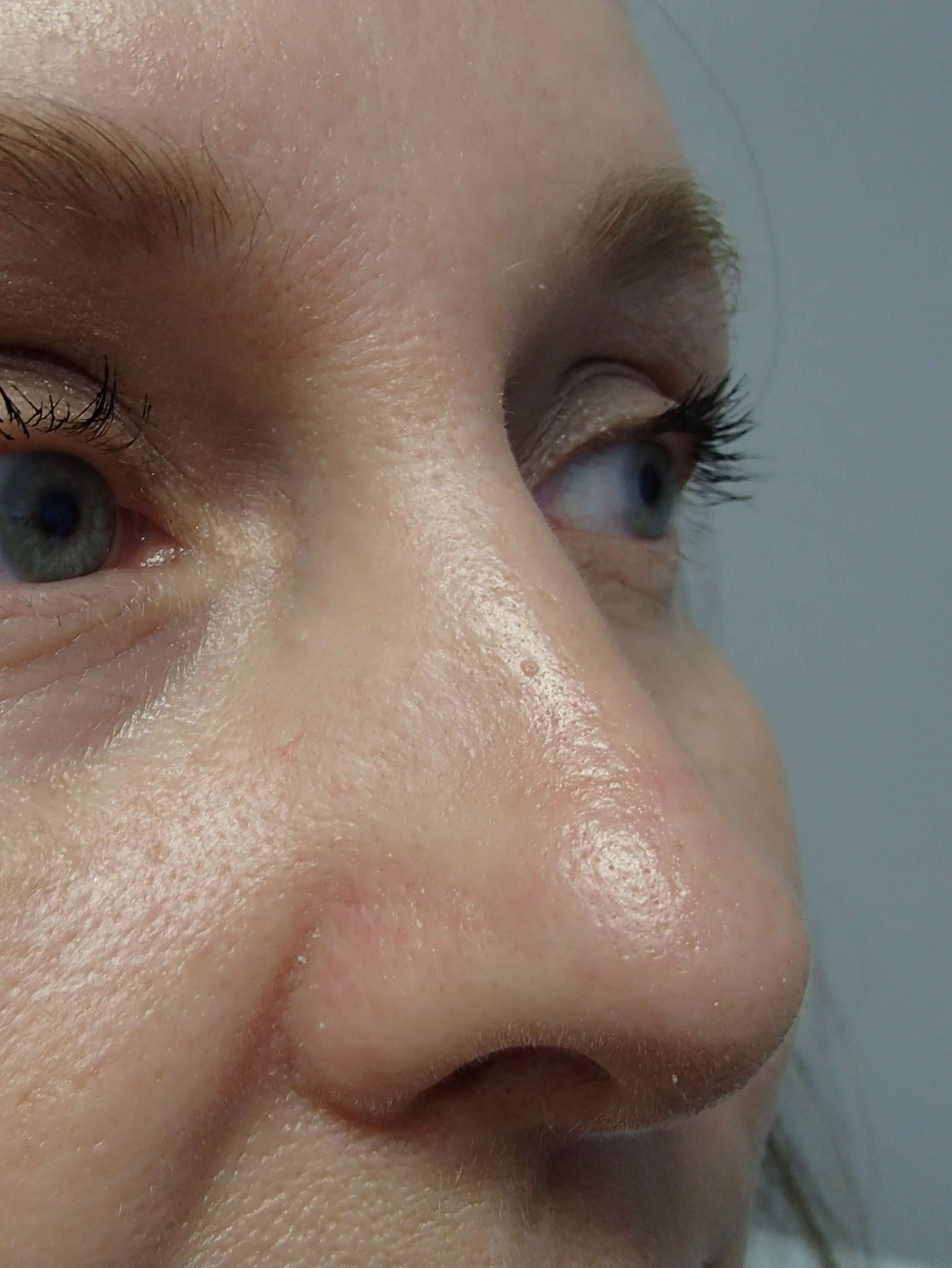 Rhinoplasty After