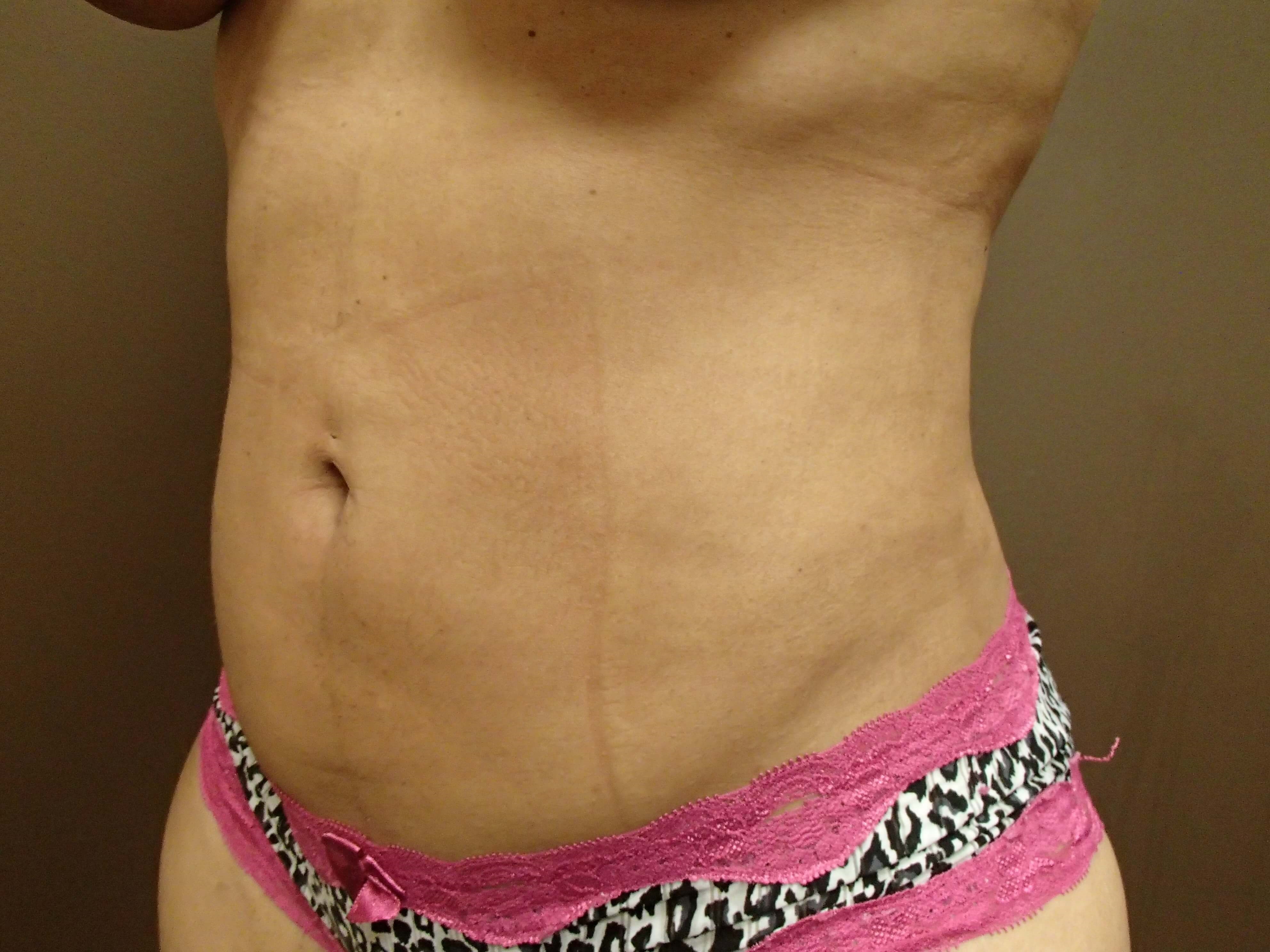 Liposuction After
