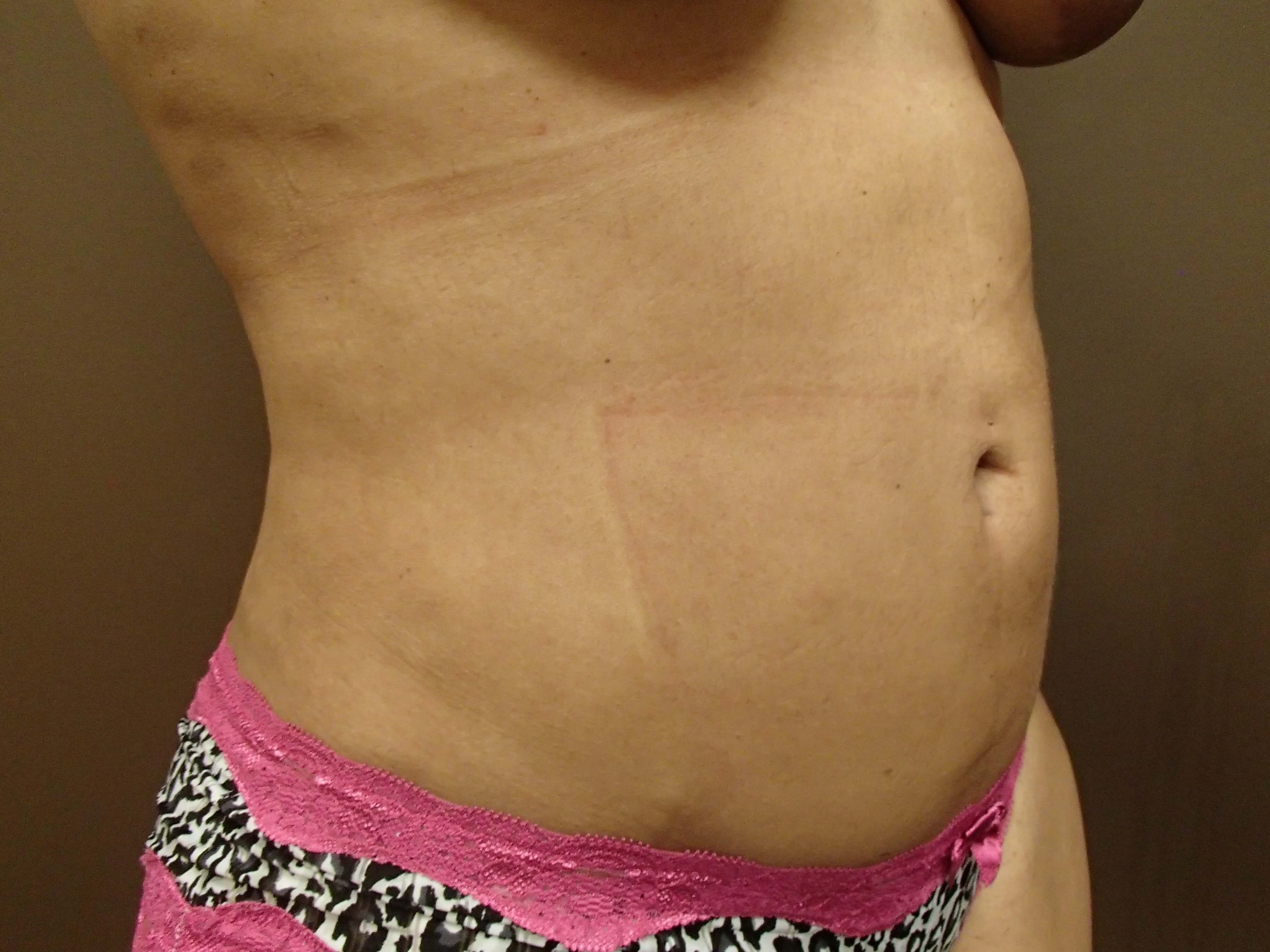 Liposuction After