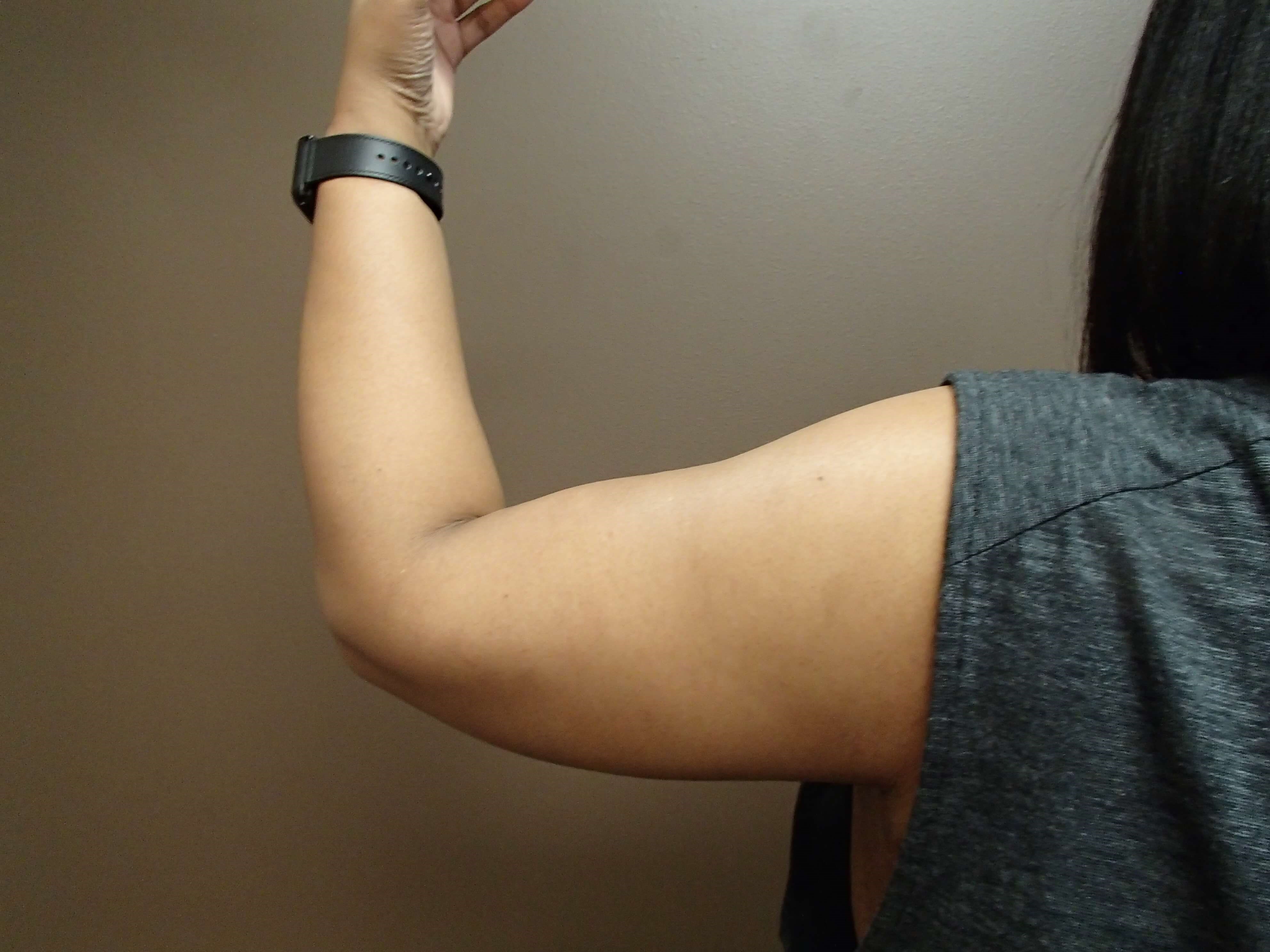 Brachioplasty and Liposuction After