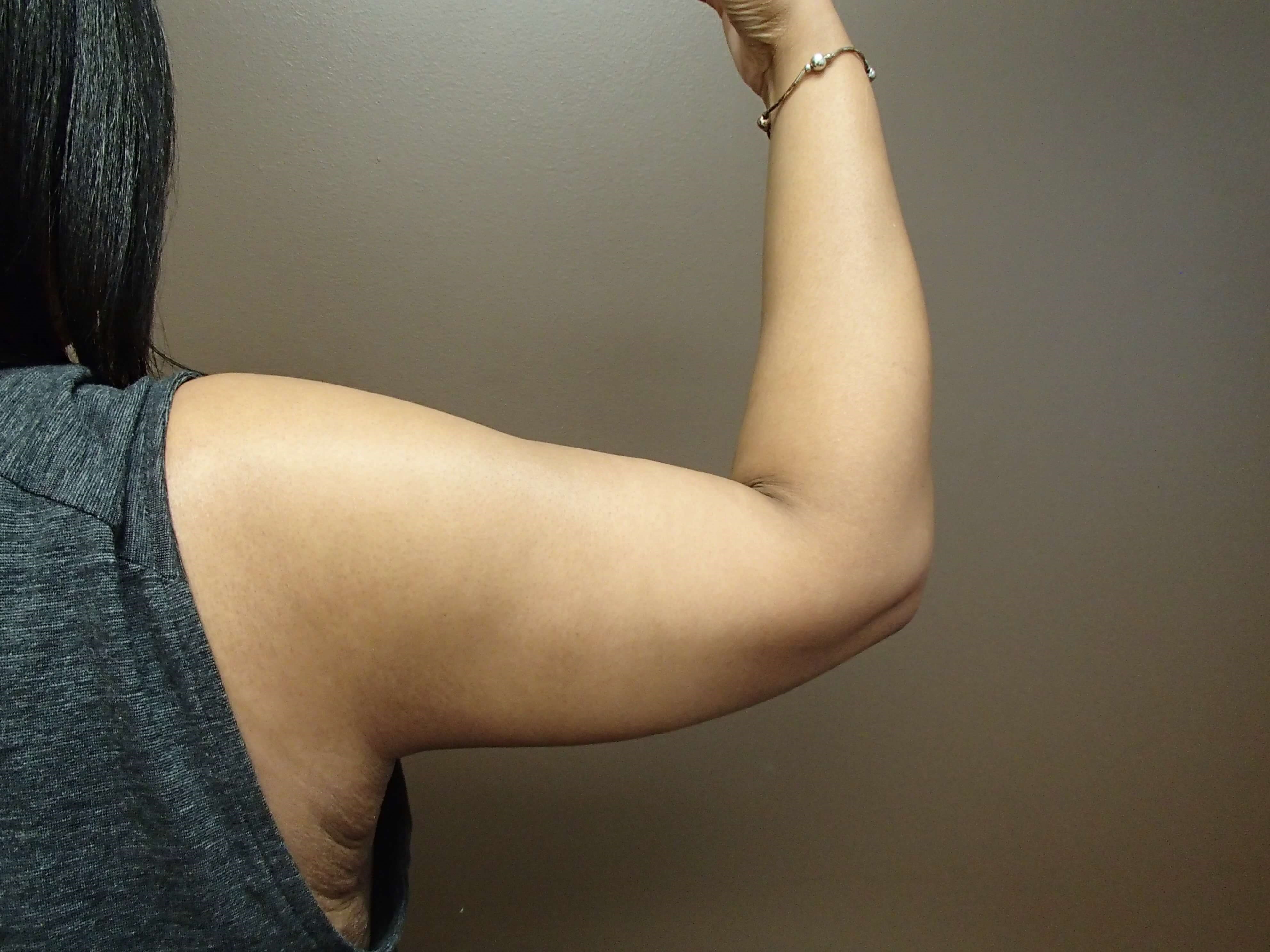 Brachioplasty and Liposuction After