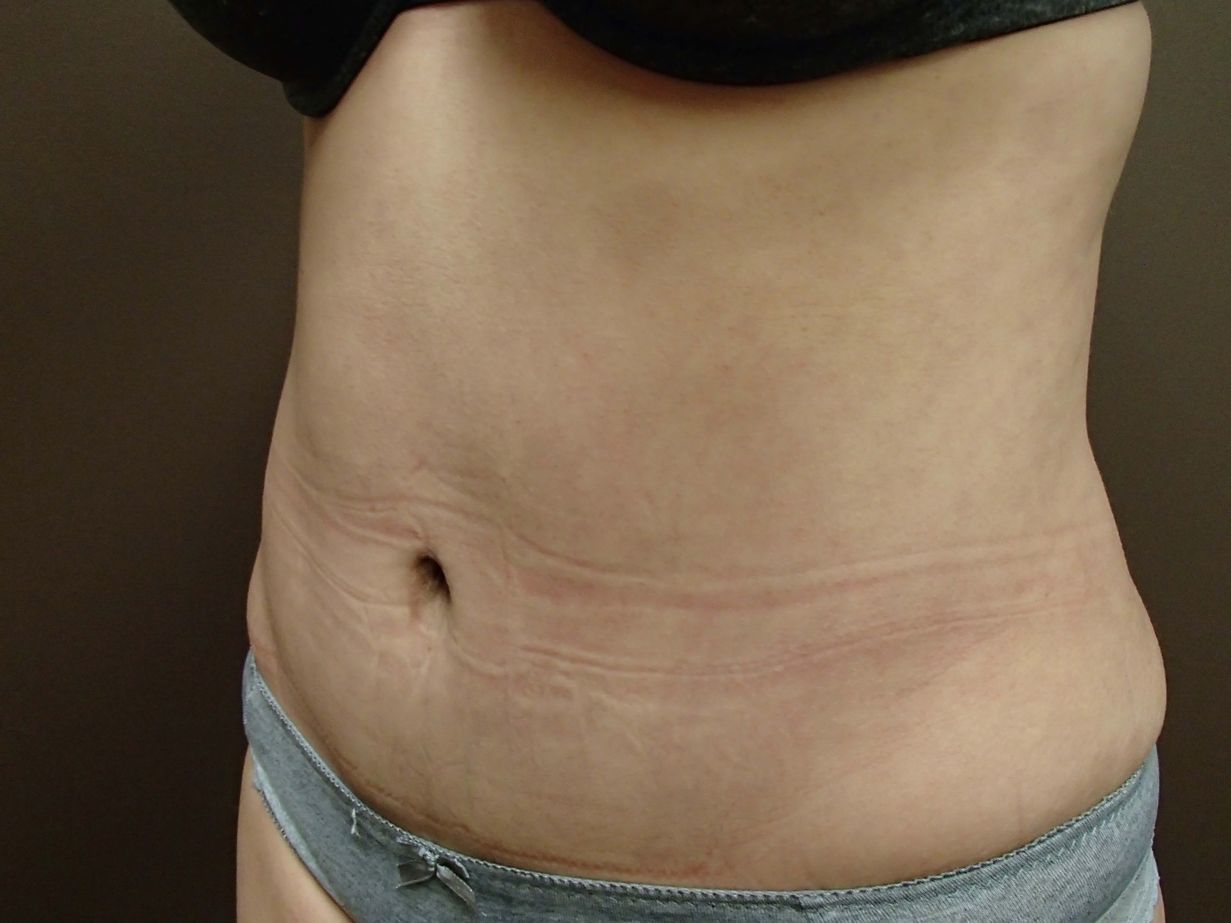 Abdominoplasty and Liposuction After