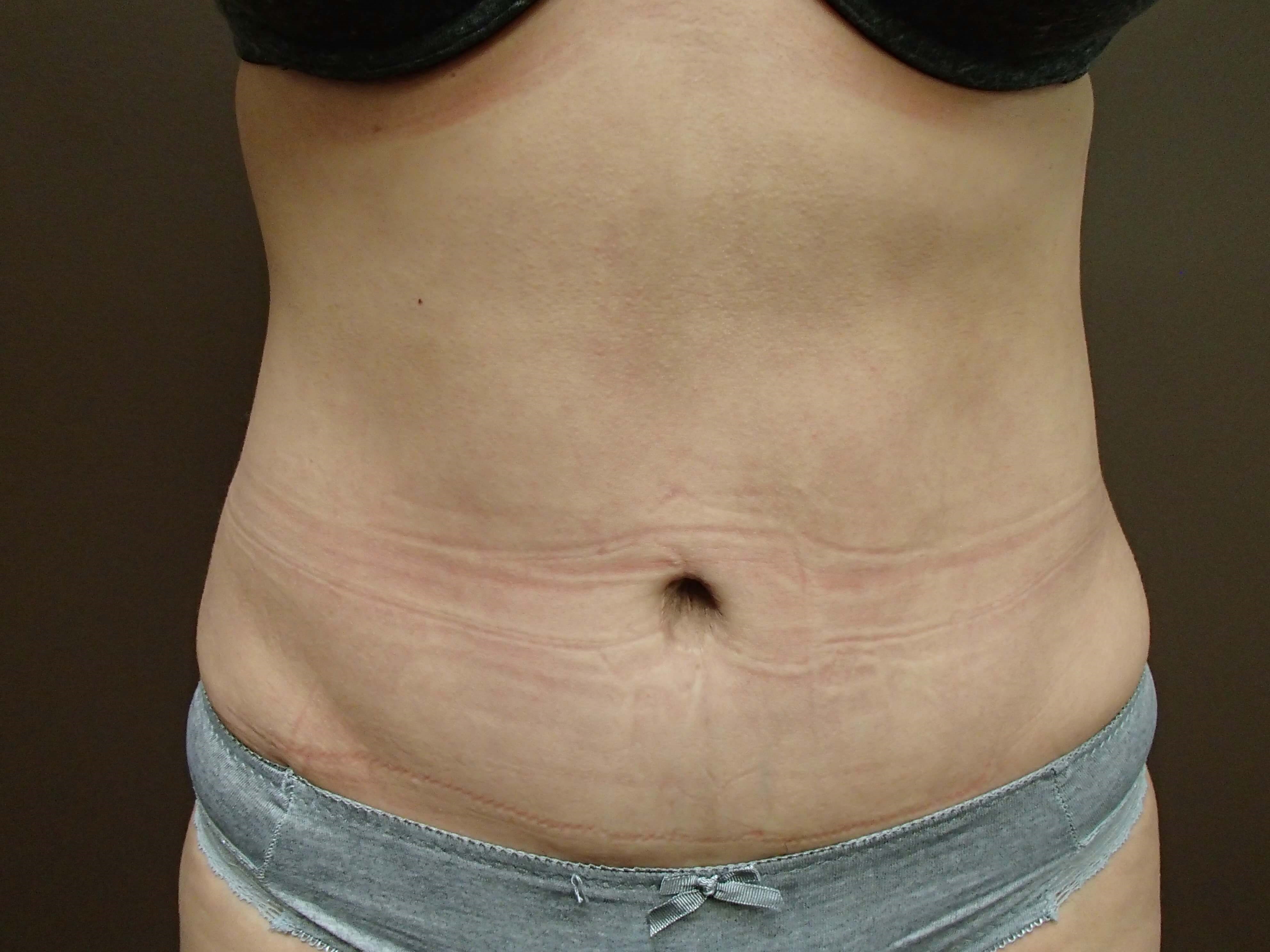 Abdominoplasty and Liposuction After