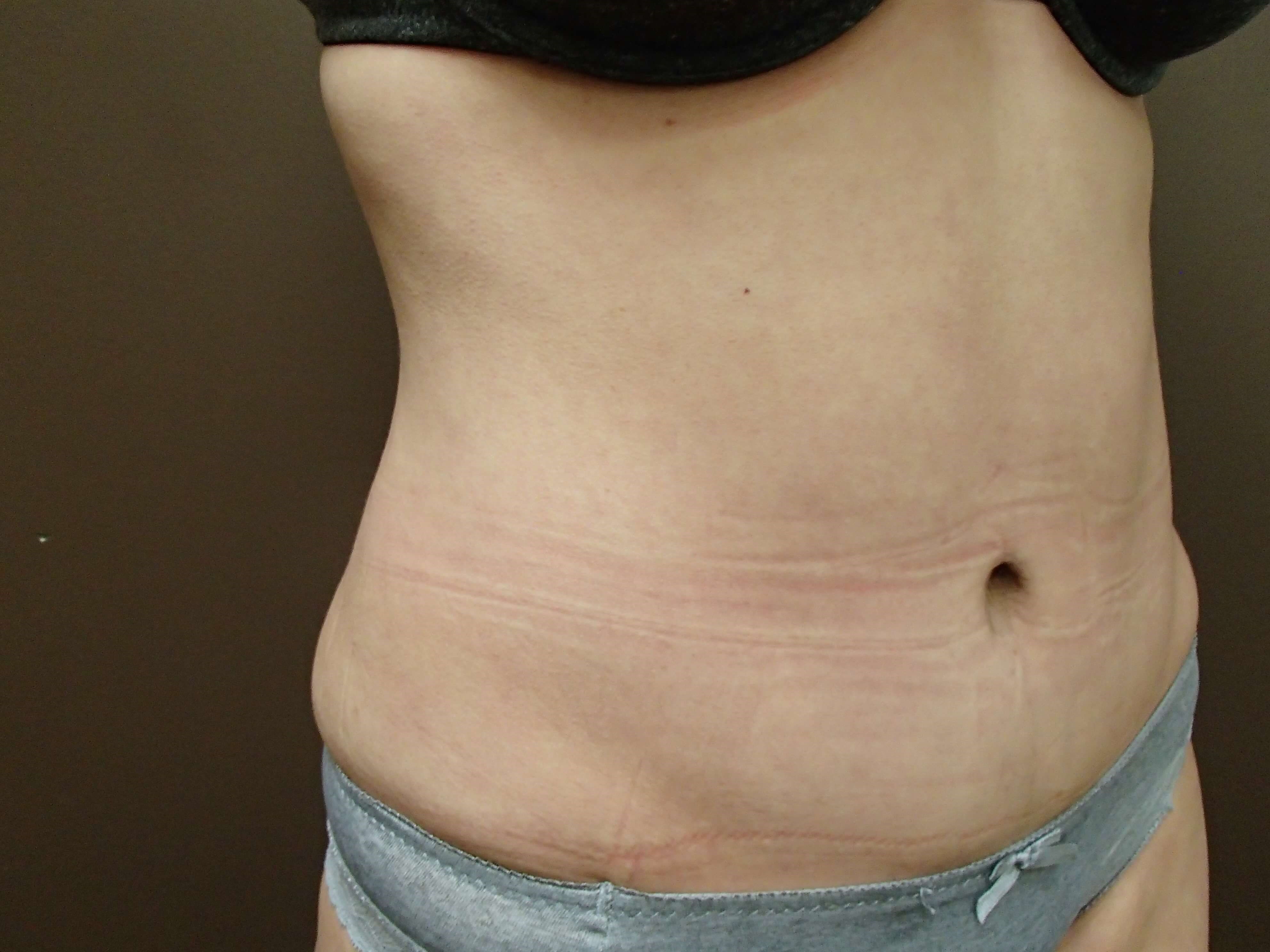 Abdominoplasty and Liposuction After