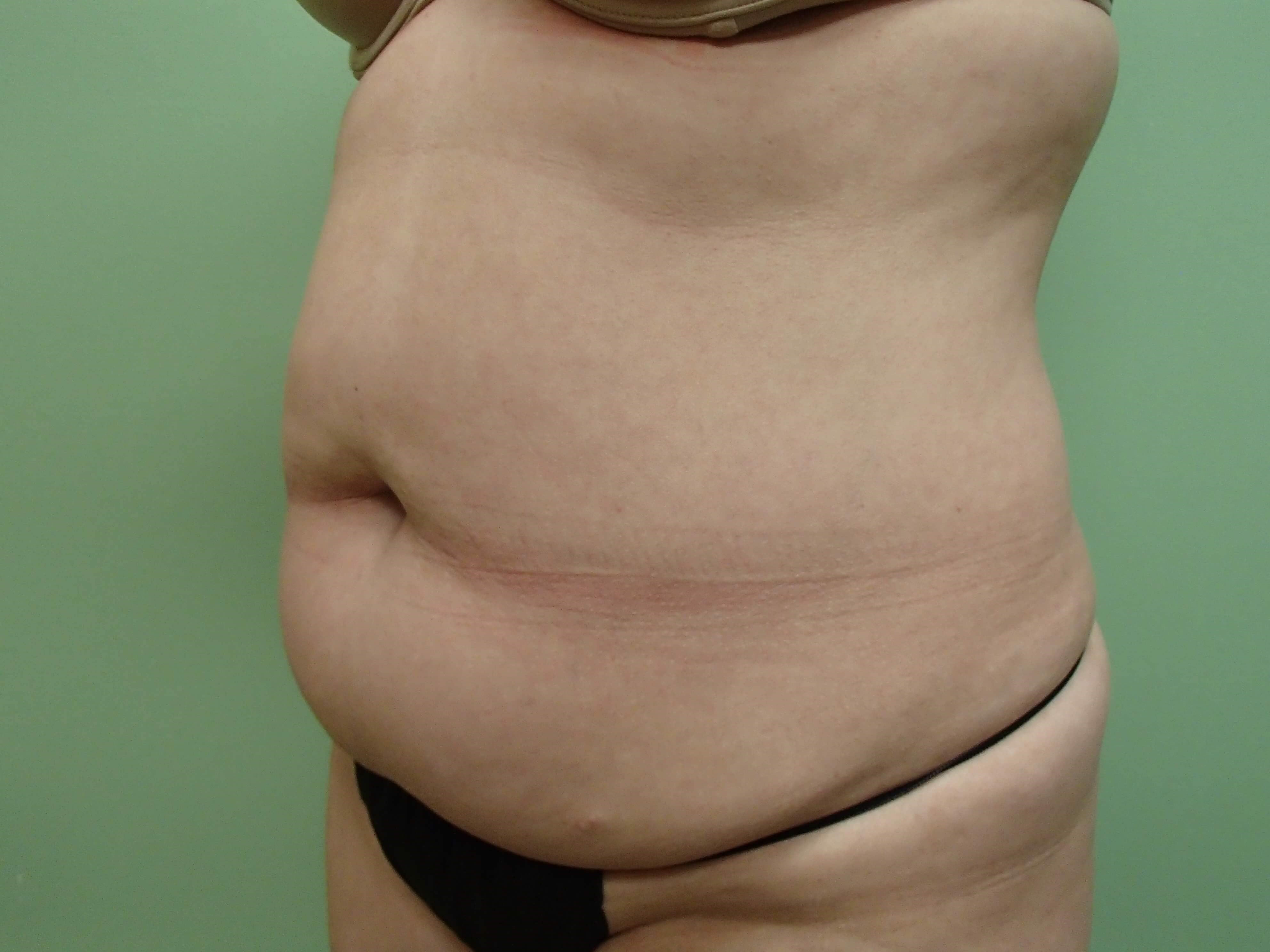 Abdominoplasty and Liposuction Before