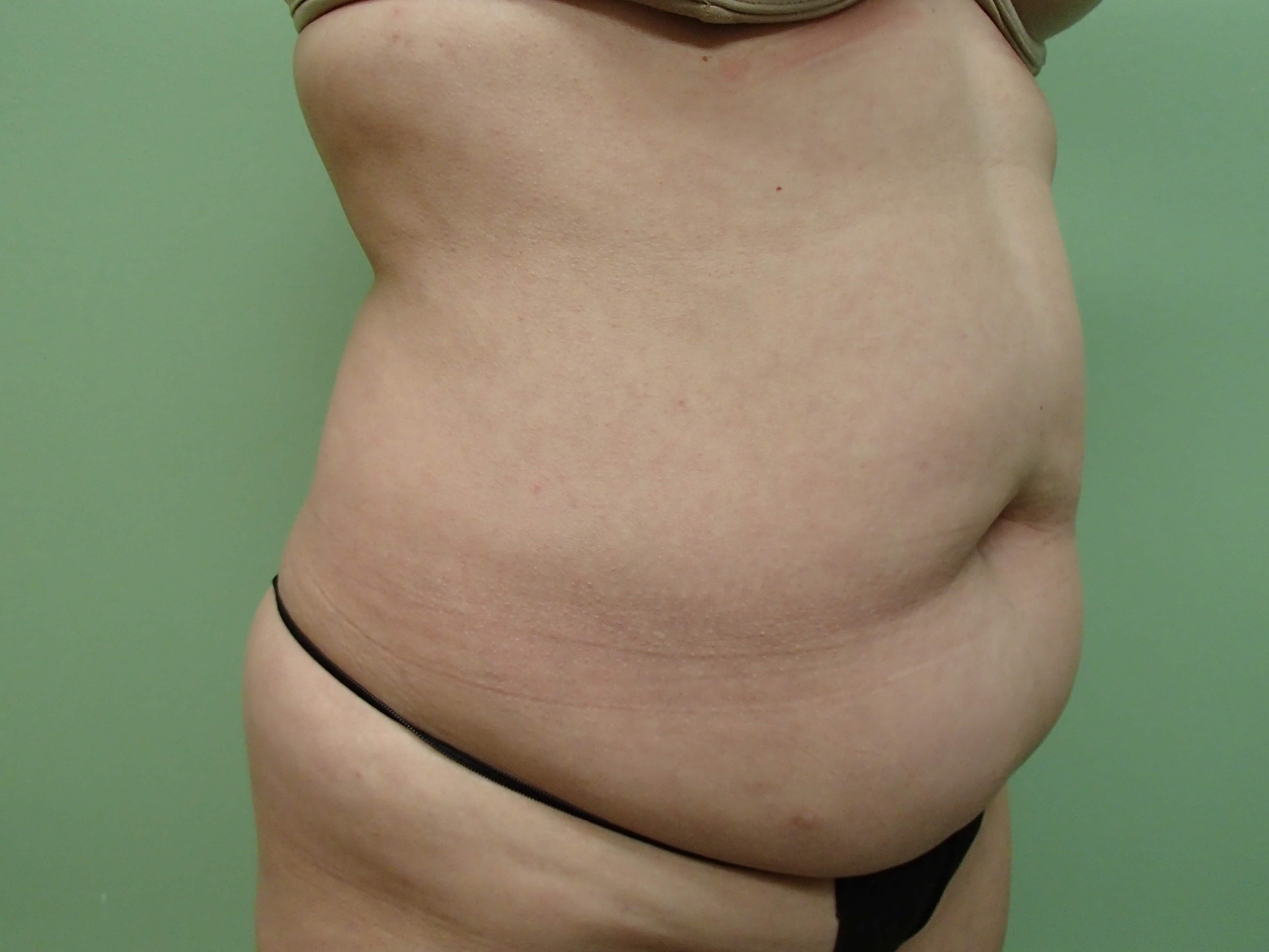 Abdominoplasty and Liposuction Before