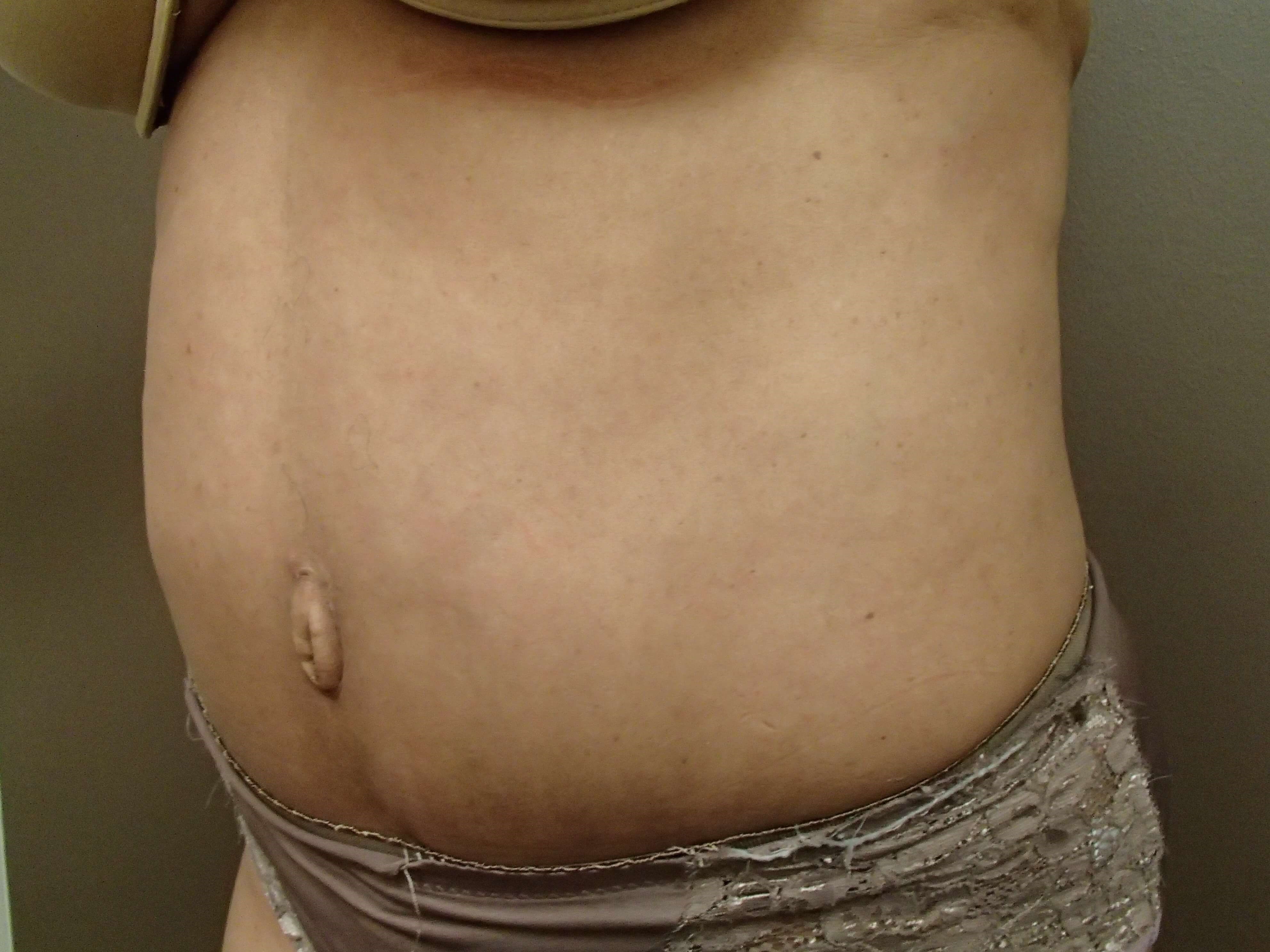 Timeless Tuck with Liposuction After